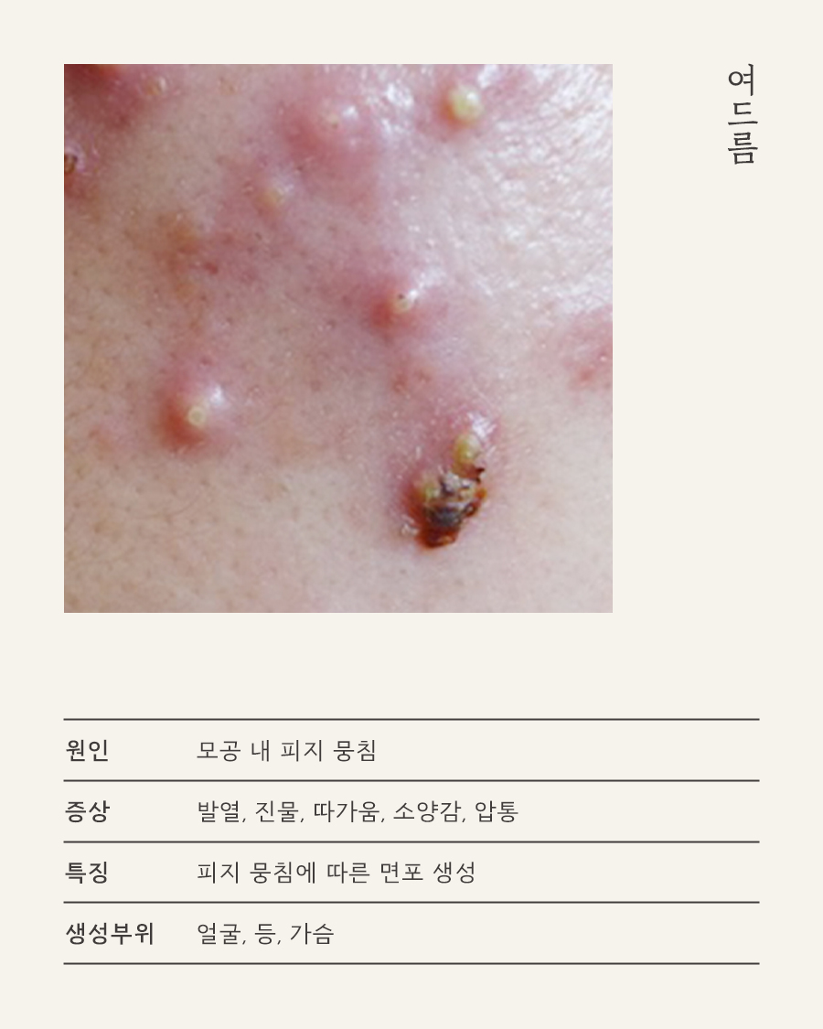[목동점] 지루성여드름 근본적으로 치료하기 위한 한방 치료 - 해율한의원