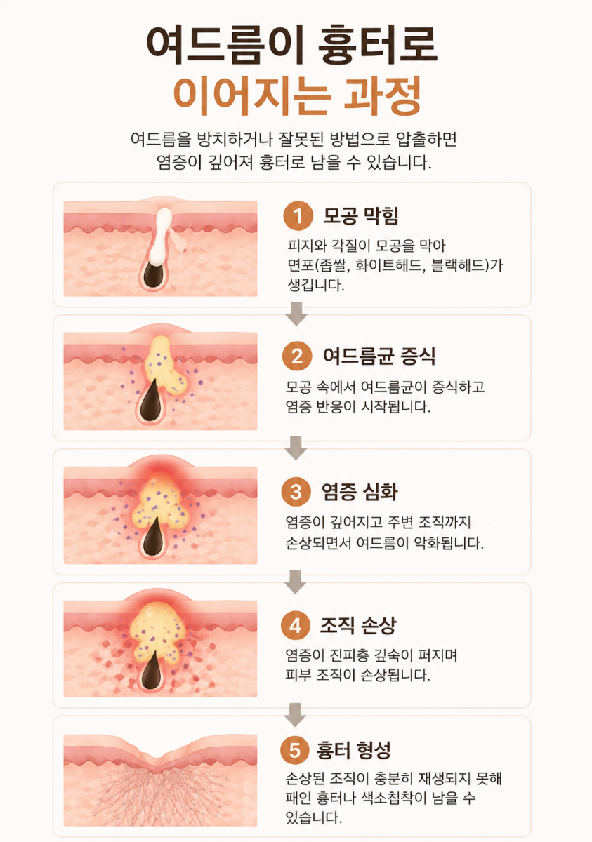 [울산점] 울산여드름피부과 흉터를 예방하는 한의원 치료에 대해 설명드립니다 - 해율한의원