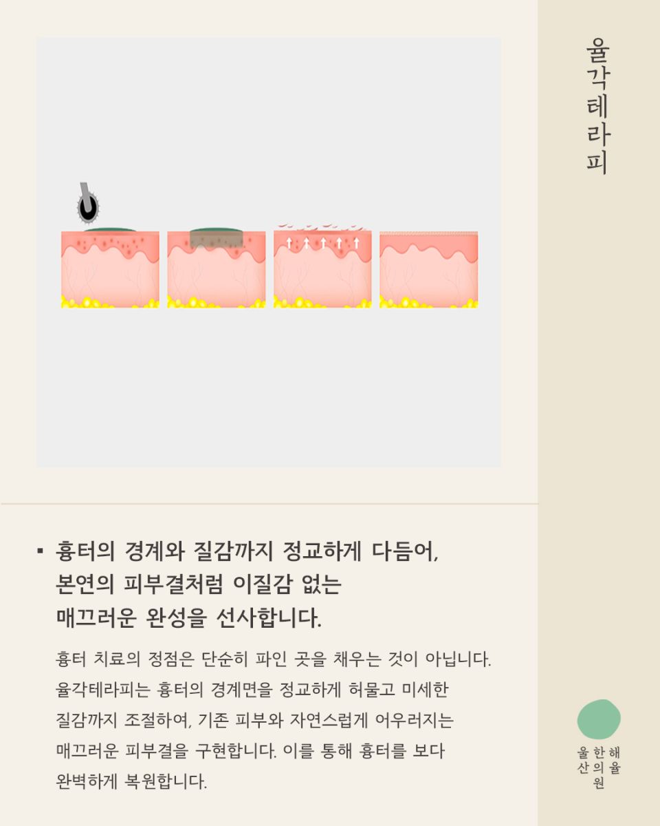 [울산점] 울산해율한의원 여드름흉터, 파인흉터 새살침과 레이저 병행치료법과 비용설명 드립니다. - 해율한의원