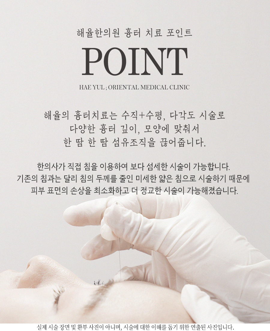 [안산점] 안산여드름흉터 오래된 흉터도 치료할 수 있나요? - 해율한의원