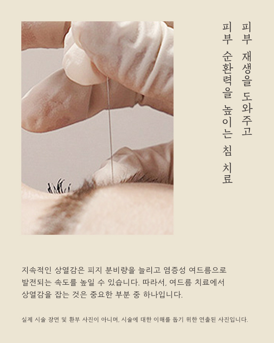 [목동점] 화곡여드름피부과 재발 막는 방법은 무엇일까요? - 해율한의원