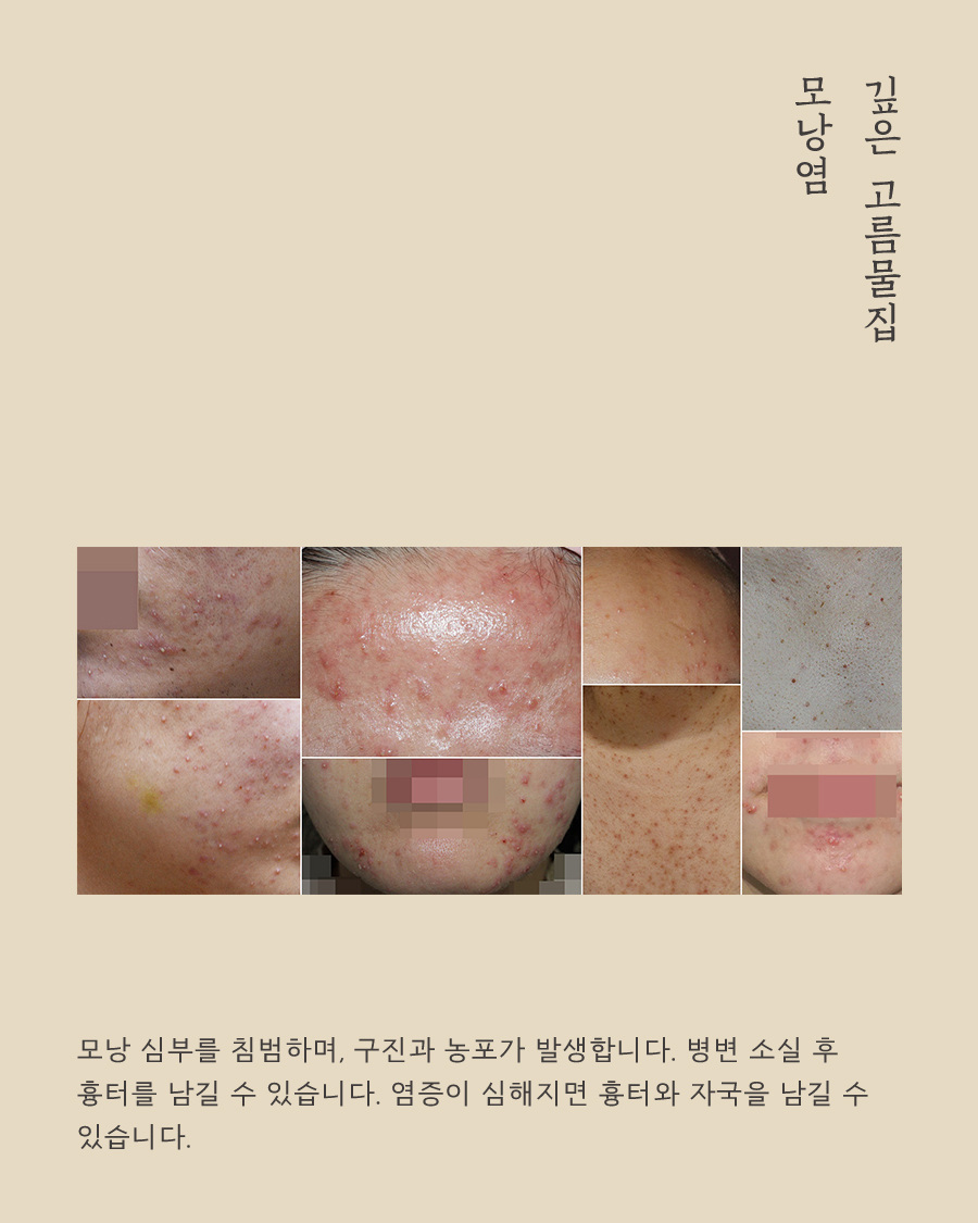 [목동점] 모낭염과 일반 여드름의 차이점 및 주 증상은 무엇인가요 - 해율한의원