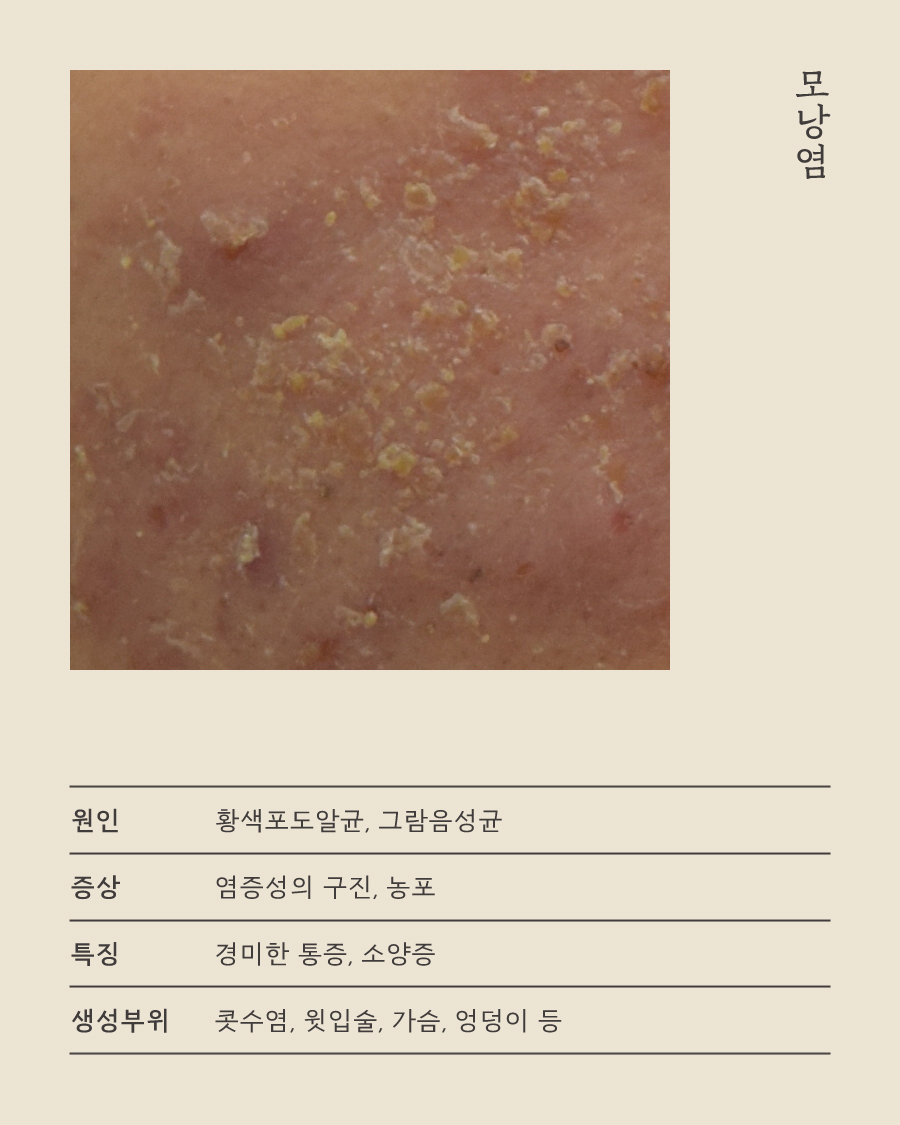[목동점] 모낭염과 일반 여드름의 차이점 및 주 증상은 무엇인가요 - 해율한의원