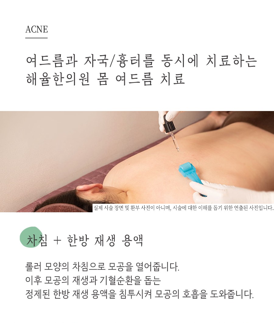 [창원점] 창원가슴여드름 가드름 긁어서 생긴 흔적, 없앨 수 있을까요? - 해율한의원