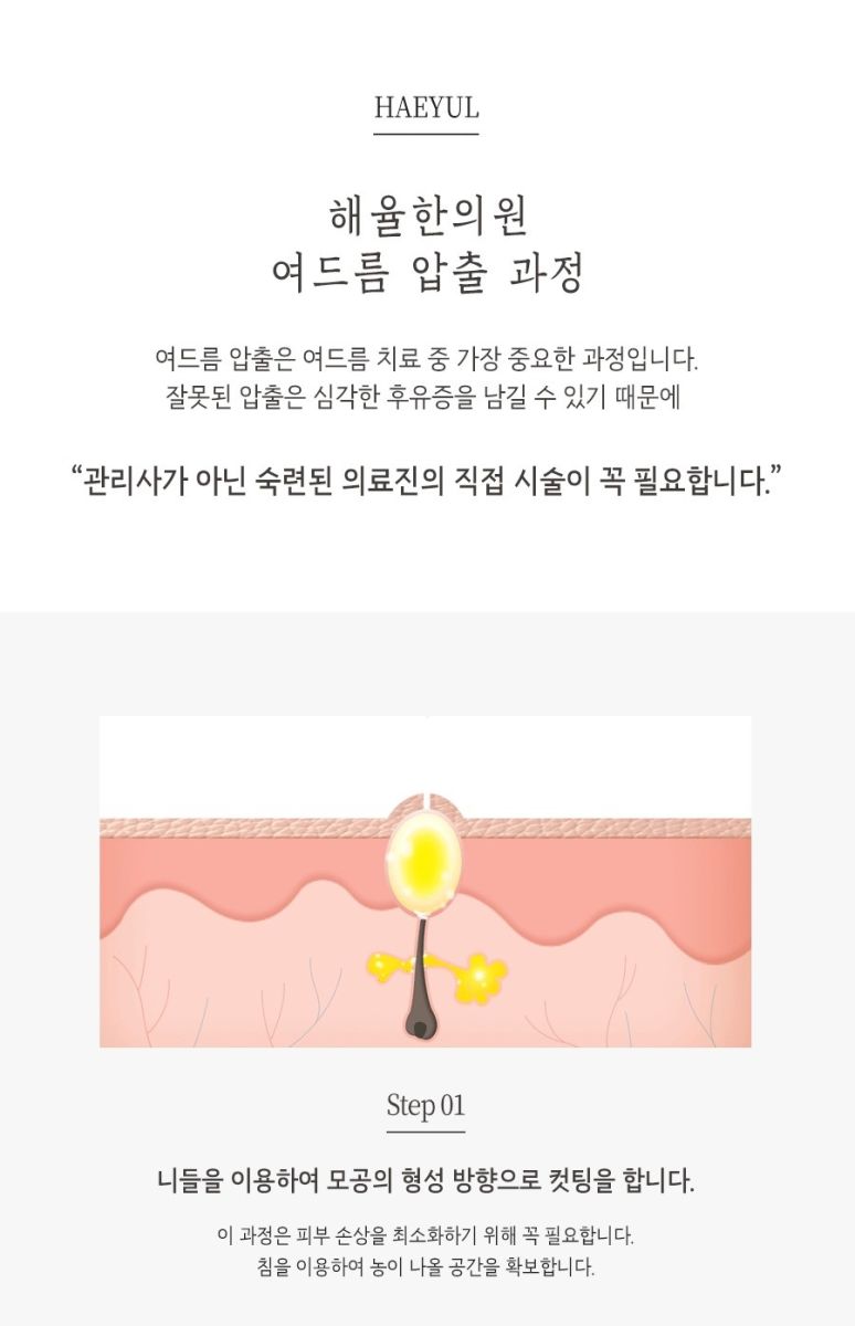 [안산점] 안산여드름한의원 압출 혼자서 하면 안되나요? - 해율한의원