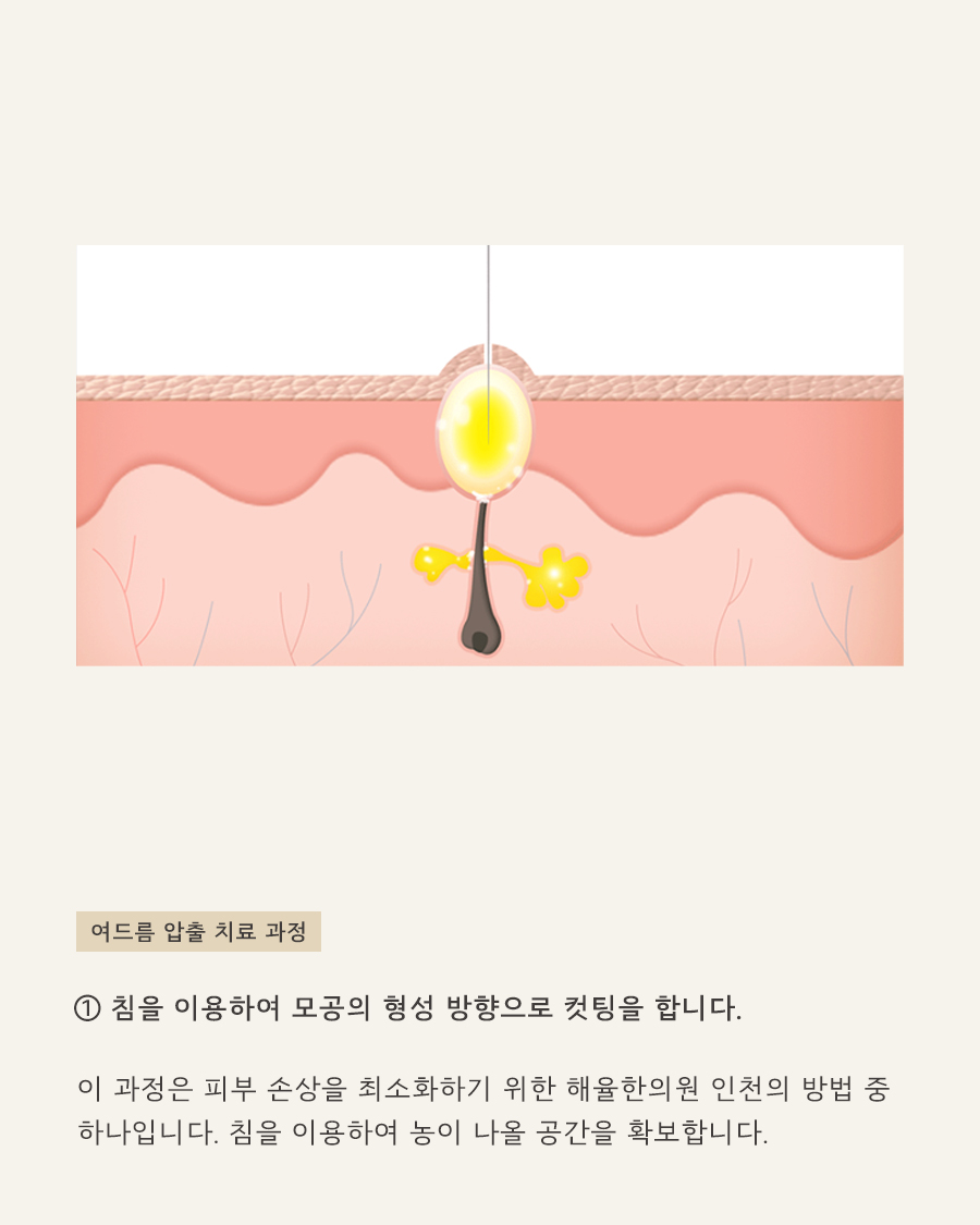 [인천점] 인천피부한의원 여드름 무조건 짜면 안되는 이유, 원장님이 설명드립니다 - 해율한의원