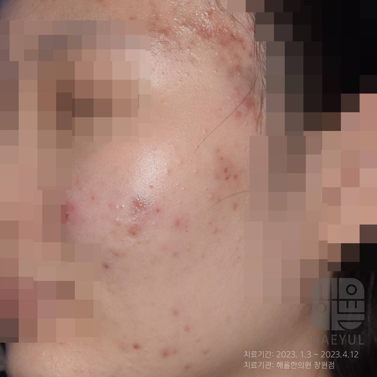 [창원점] 창원피부한의원 갑자기 얼굴이 뒤집어지는 이유는? - 해율한의원