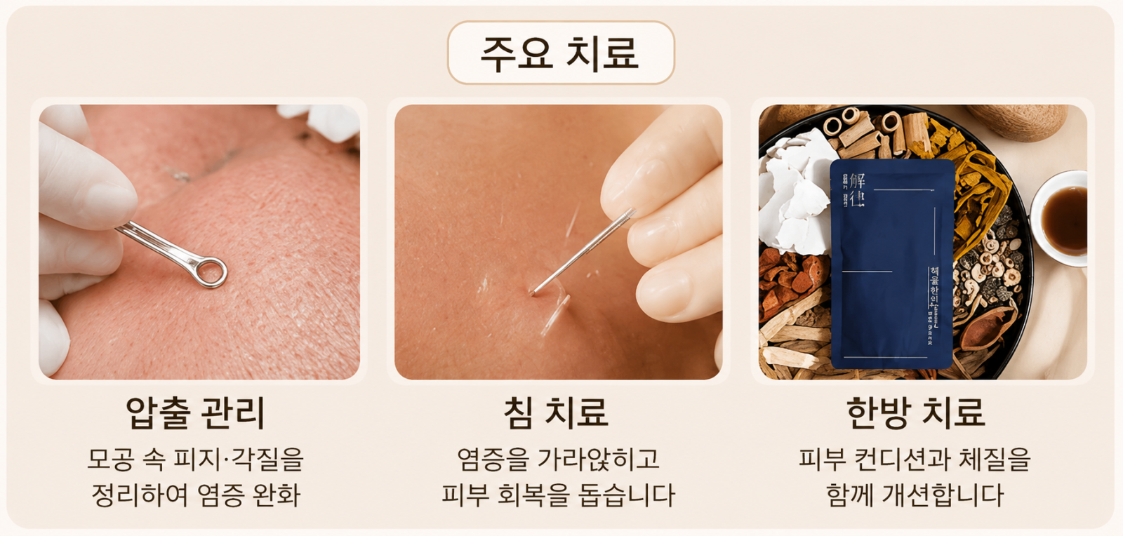 [안양점] 안양여드름치료 기간은 얼마나 걸릴까요? - 해율한의원
