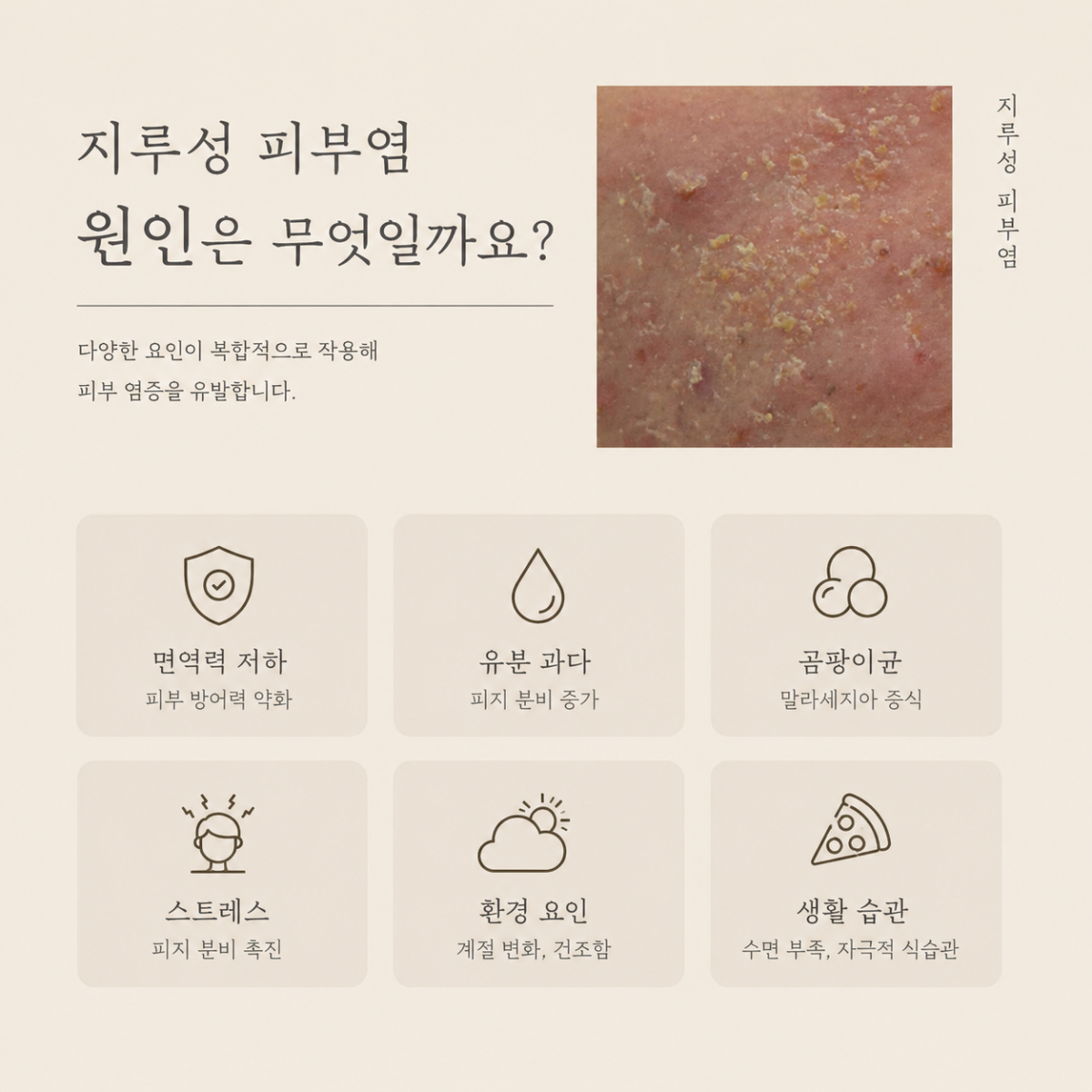 [울산점] 울산지루성피부염 여드름과 어떻게 다를까요? 원장님이 설명드립니다 - 해율한의원