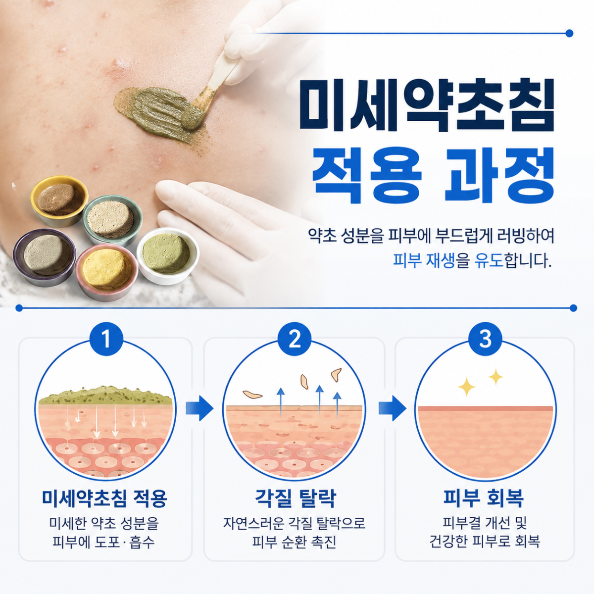 [강남점] 강남가슴여드름 생기는 순간부터 달라져야 할 관리법 - 해율한의원