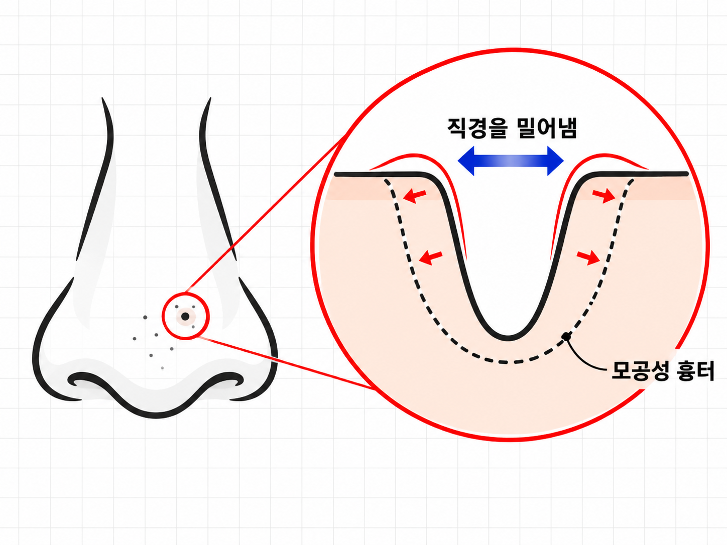 염증 이후 모공 주변 조직이 비후되면서 모공 직경이 넓어진 모습을 보여주는 그림 