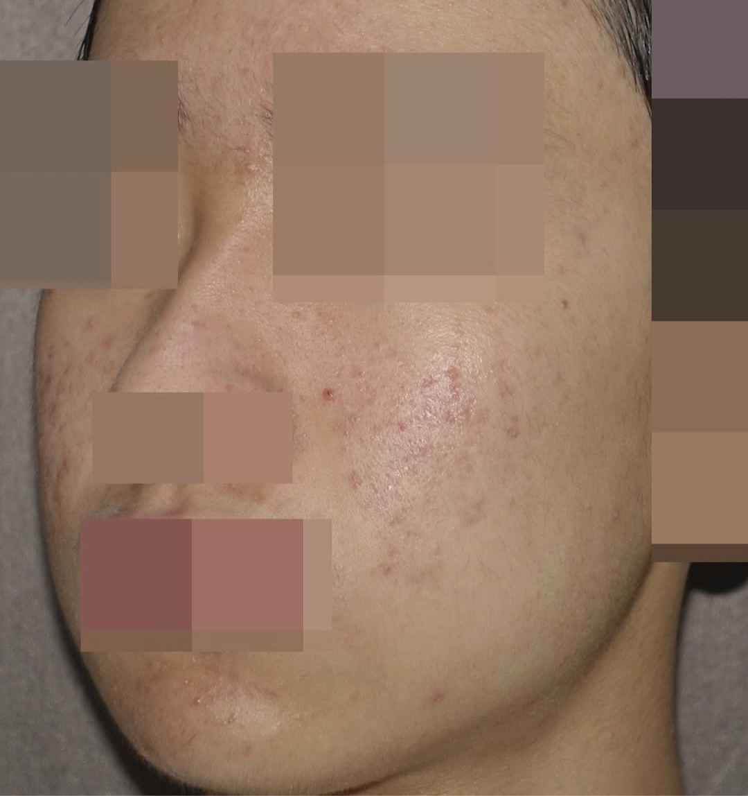 [홍대점] 홍대피부한의원 좁쌀부터 염증성 여드름까지 종류별 특징 설명드립니다 - 해율한의원
