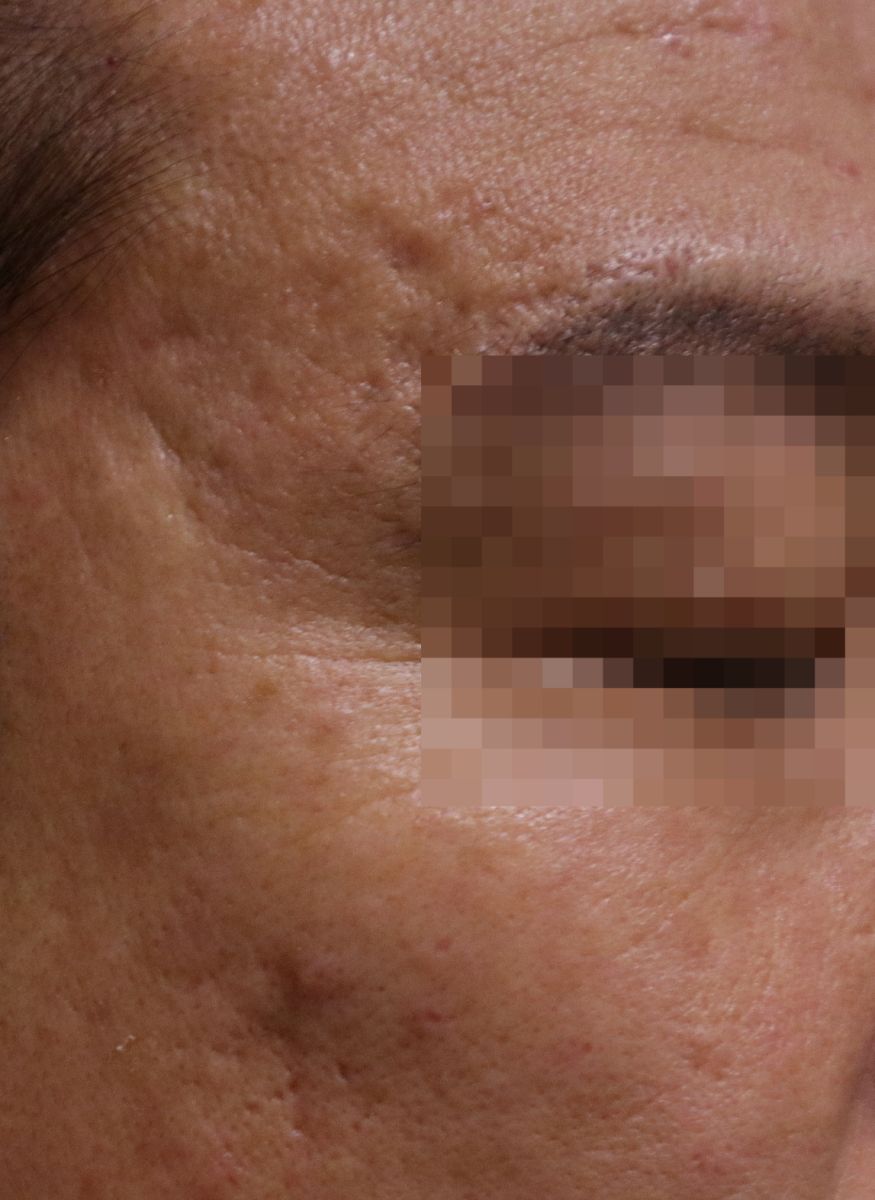 [수원점] 20년 이상 오래된 흉터도 새살침으로 채울 수 있나요? - 해율한의원
