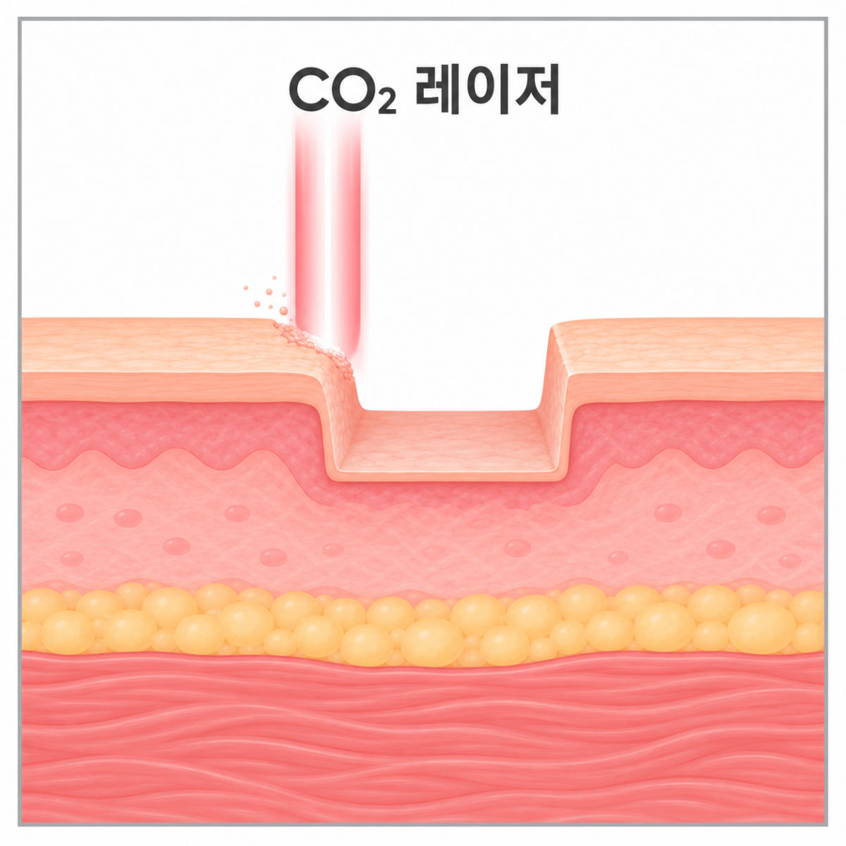 CO2 레이저의 작용방식을 보여주는 사진