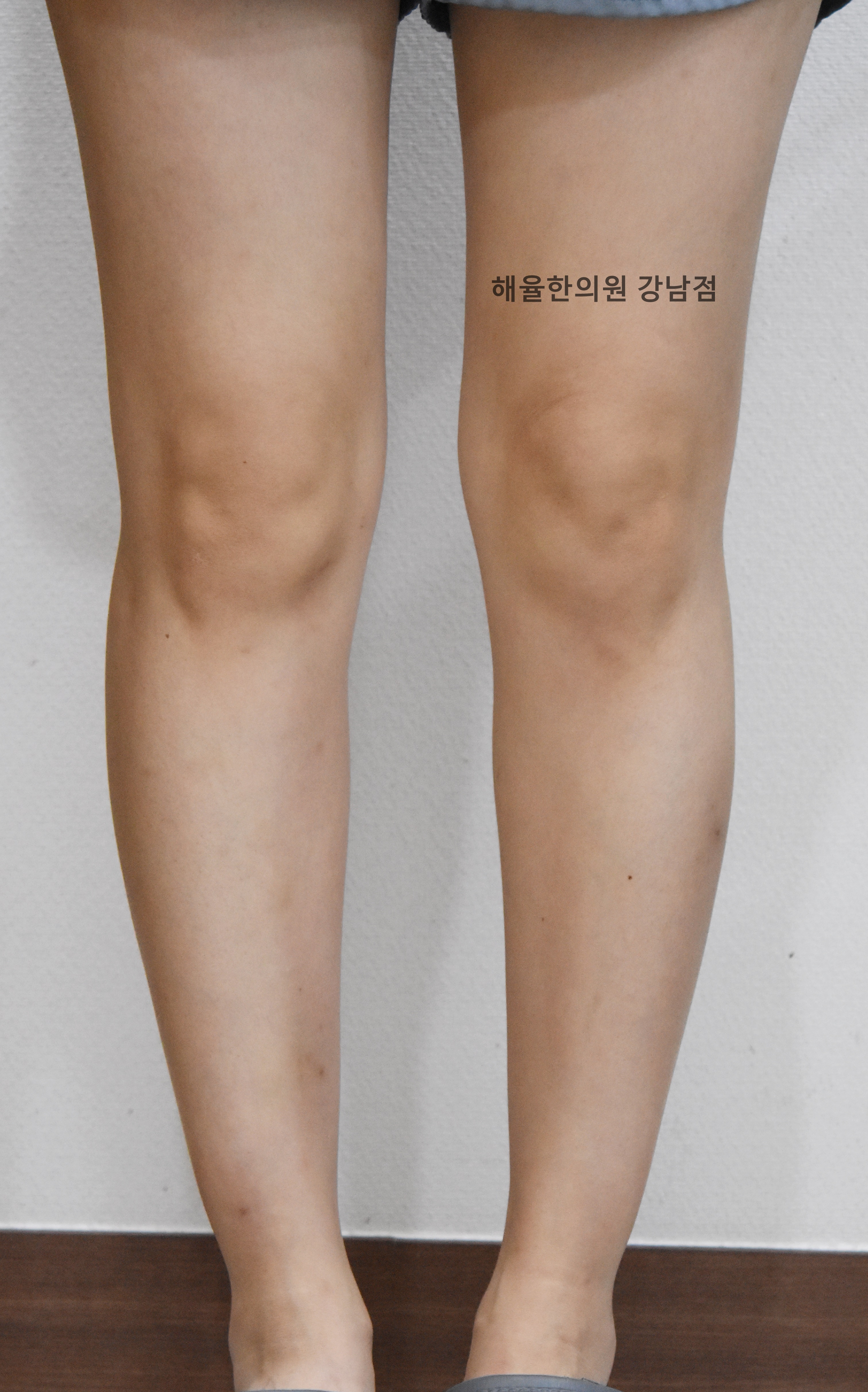 [강남점] 팔다리 색소자국 치료 후 사진 - 해율한의원