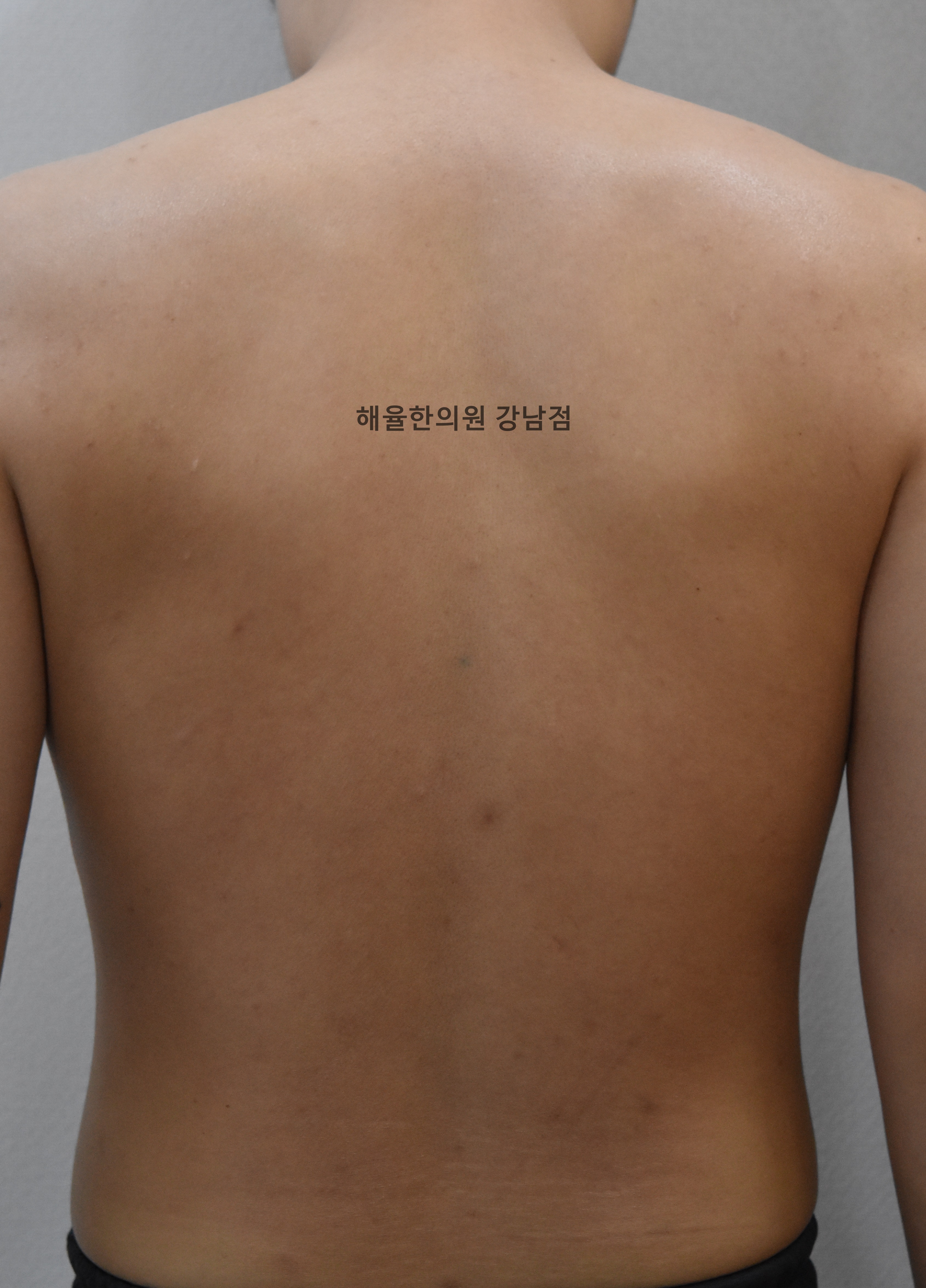 [강남점] 등여드름 치료 후 사진 - 해율한의원