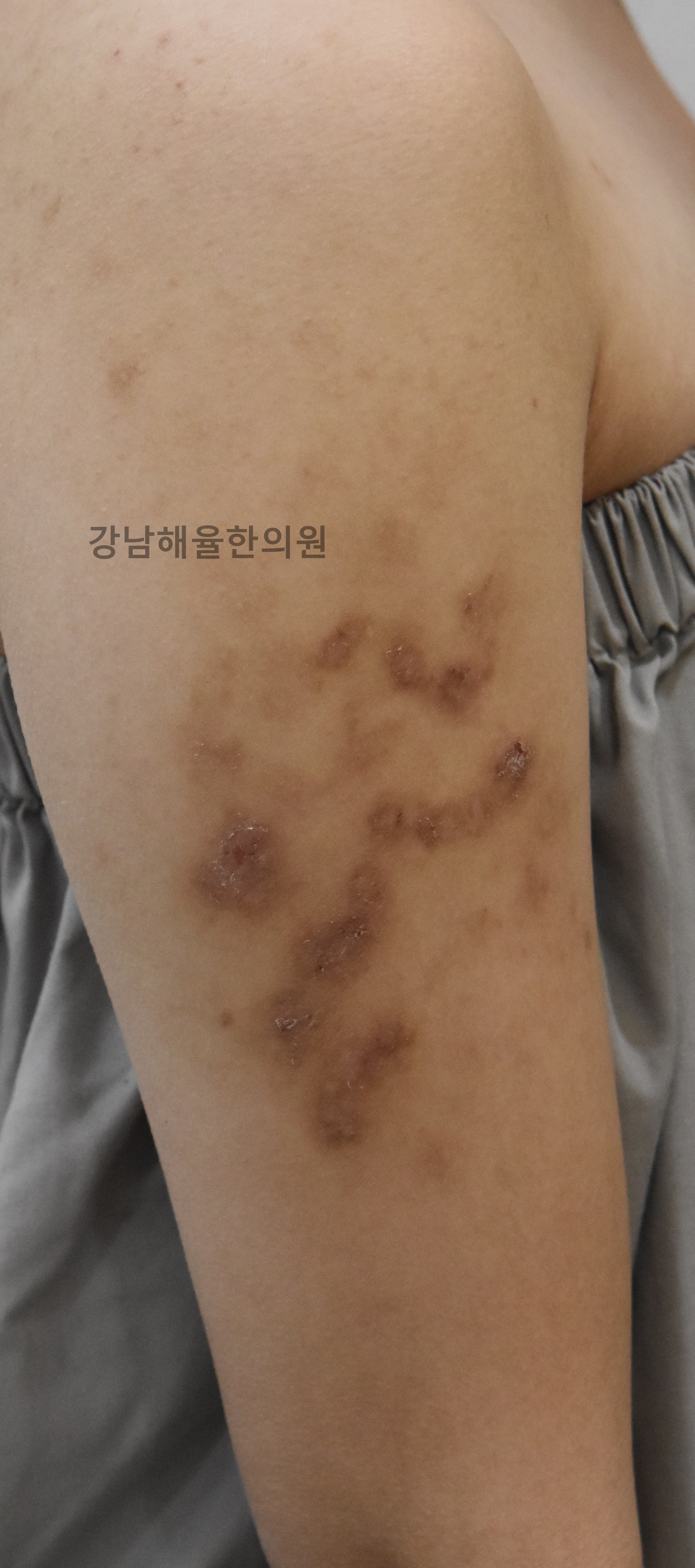 [강남점] 아토피흉터 치료 전 사진 - 해율한의원