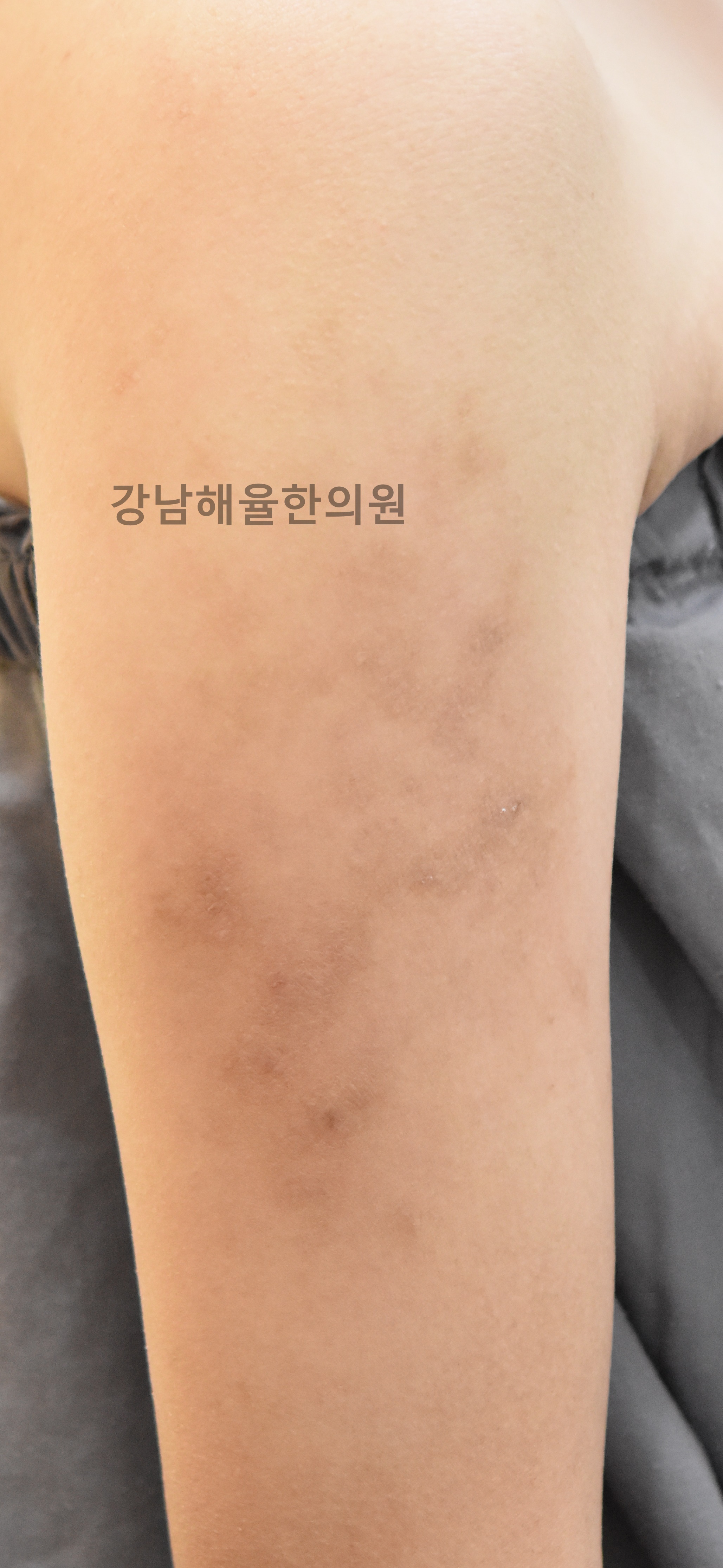 [강남점] 아토피흉터 치료 후 사진 - 해율한의원