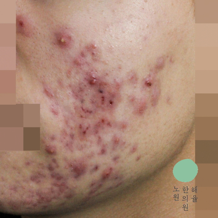 [노원점] 얼굴화농성여드름 치료 전 사진 - 해율한의원