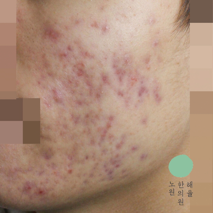 [노원점] 얼굴화농성여드름 치료 후 사진 - 해율한의원