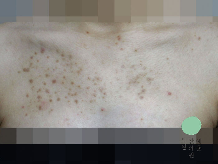 [노원점] 가슴여드름 치료 전 사진 - 해율한의원
