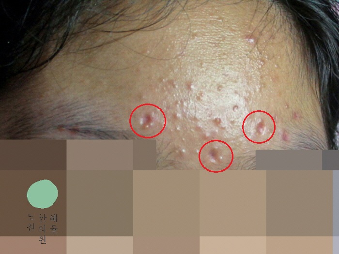 [노원점] 손톱/수두흉터/점뺀흉터 치료 전 사진 - 해율한의원