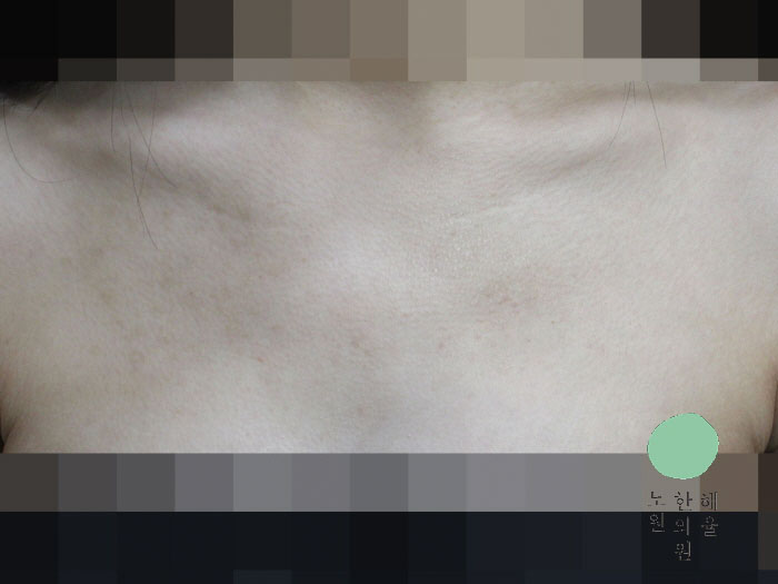 [노원점] 가슴여드름 치료 후 사진 - 해율한의원