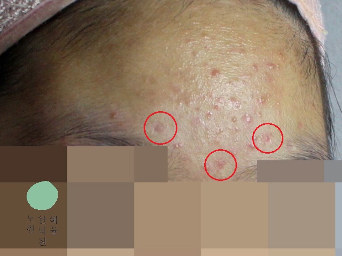 [노원점] 손톱/수두흉터/점뺀흉터 치료 후 사진 - 해율한의원