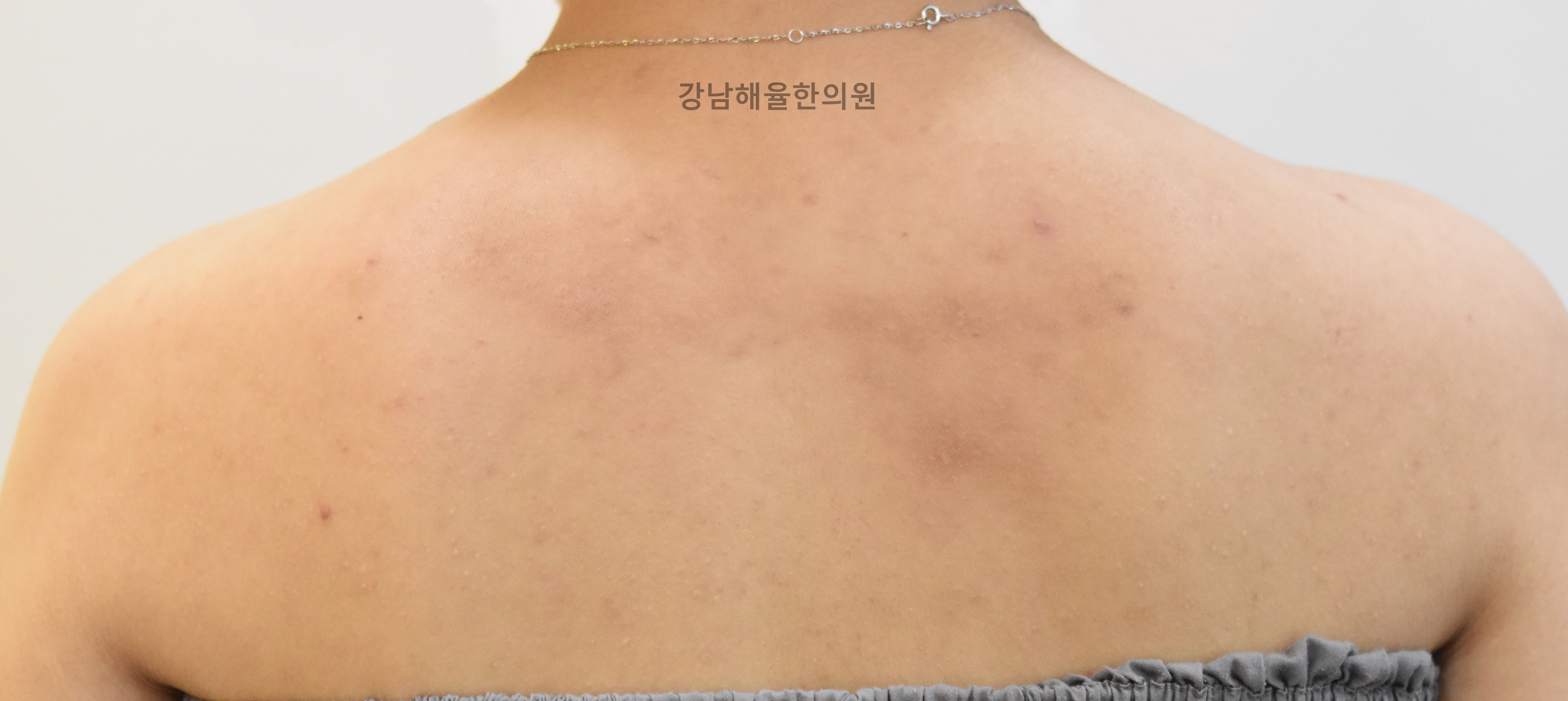 [강남점] 아토피흉터 치료 후 사진 - 해율한의원