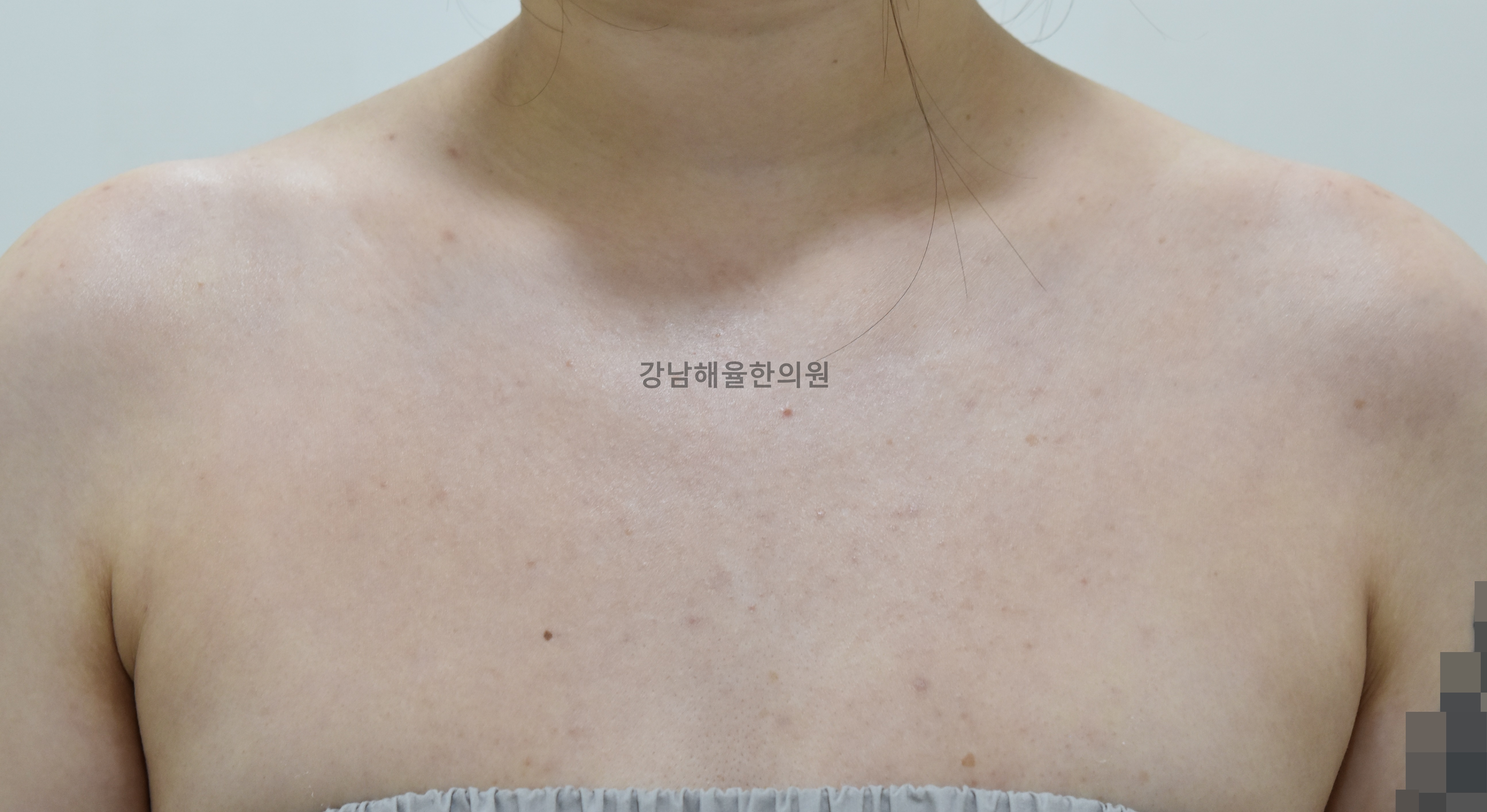 [강남점] 가슴여드름 치료 후 사진 - 해율한의원