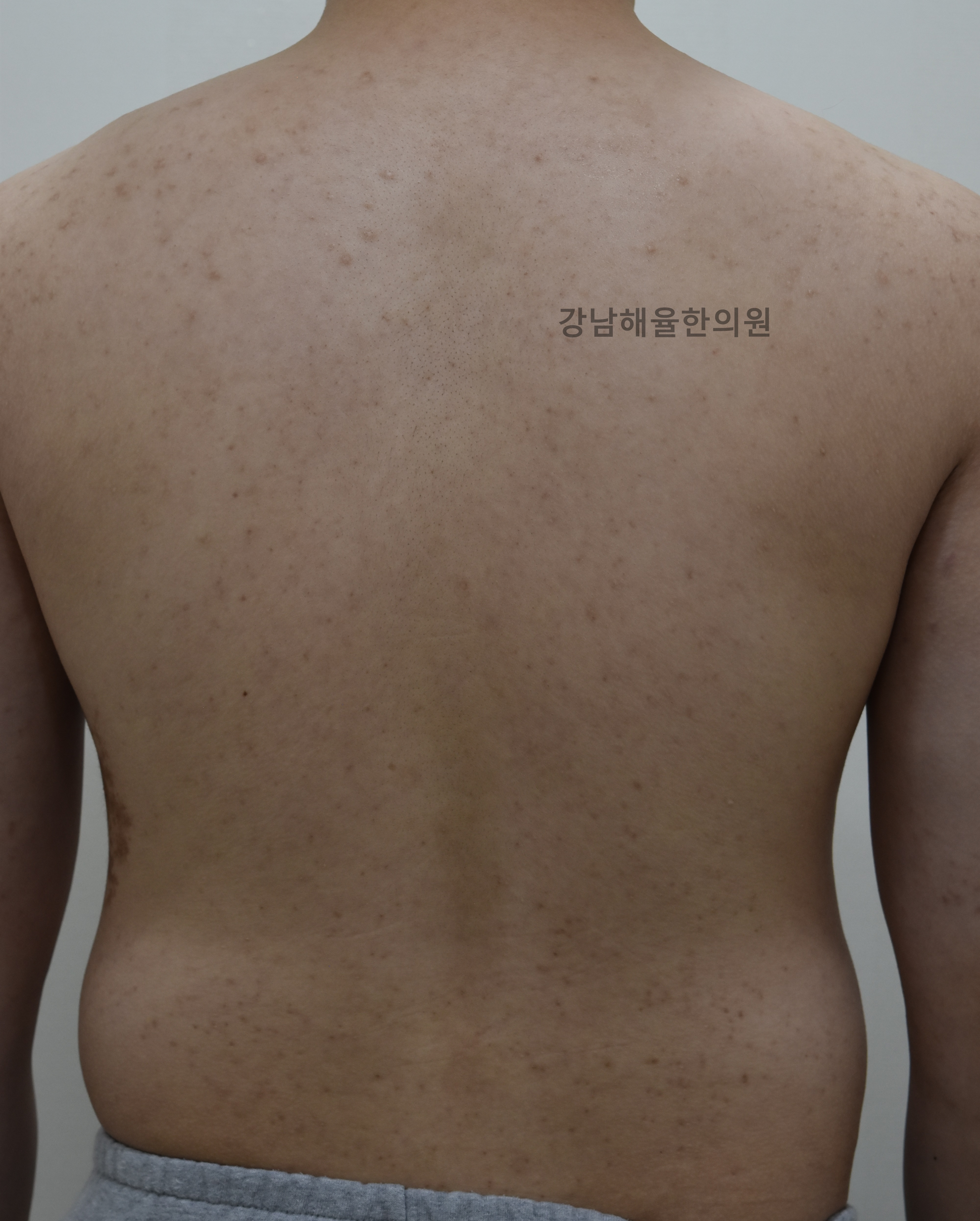 [강남점] 등여드름 치료 전 사진 - 해율한의원