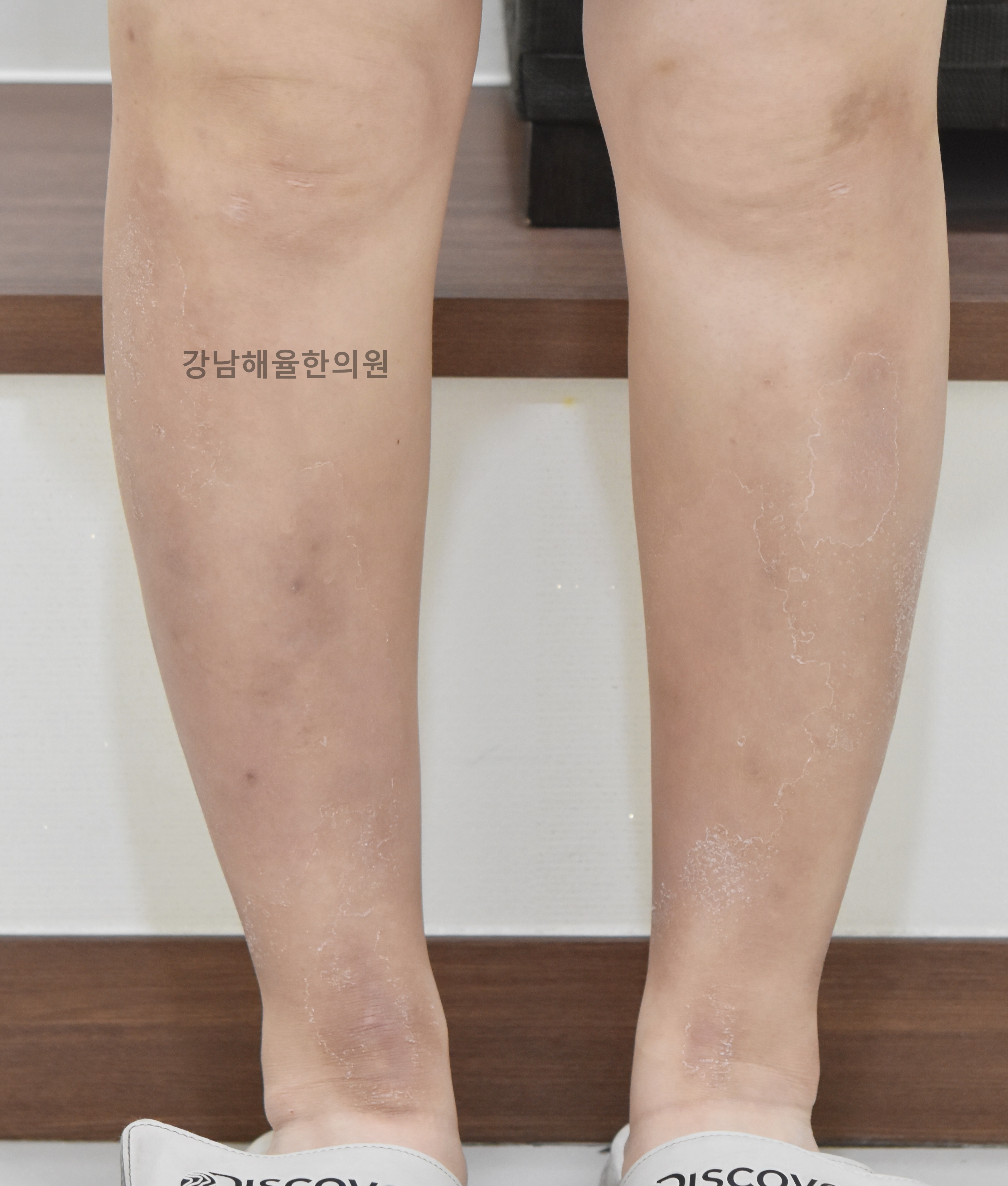 [강남점] 팔다리 색소자국 치료 후 사진 - 해율한의원