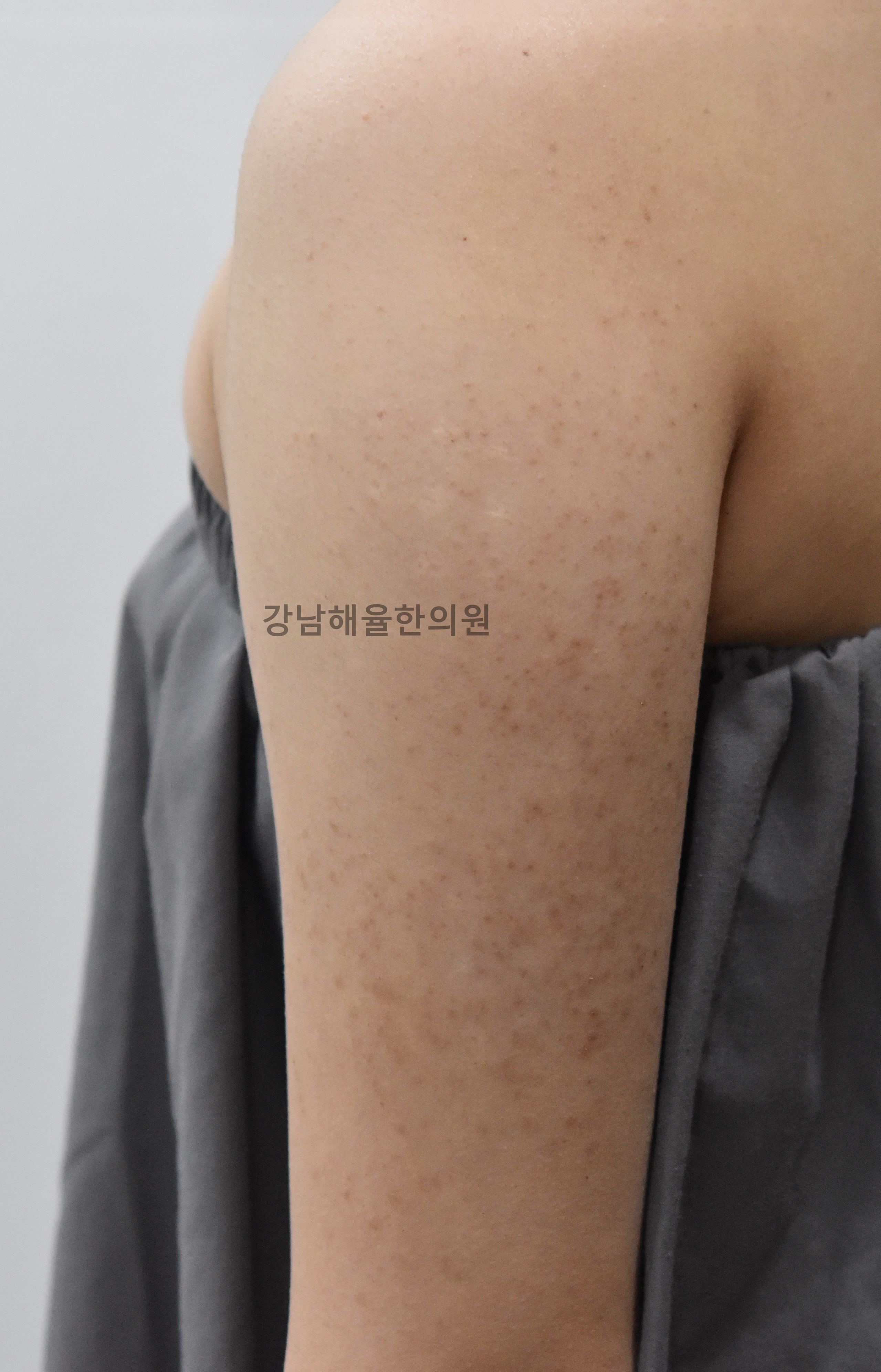 [강남점] 모공각화증 치료 전 사진 - 해율한의원