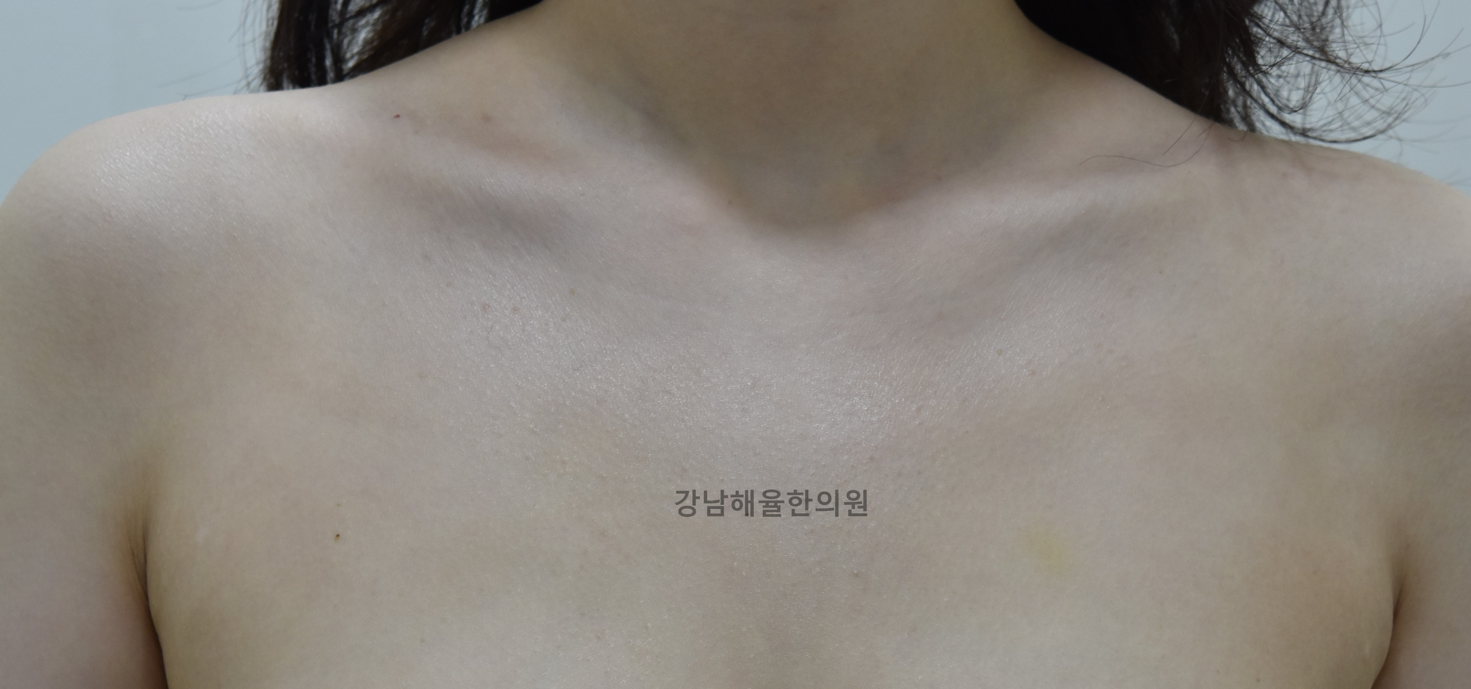 [강남점] 가슴여드름 치료 후 사진 - 해율한의원