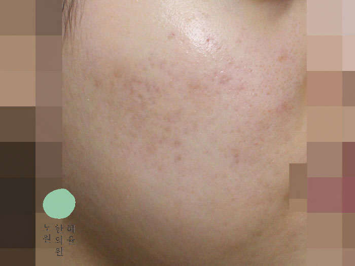 [노원점] 여드름자국 치료 후 사진 - 해율한의원