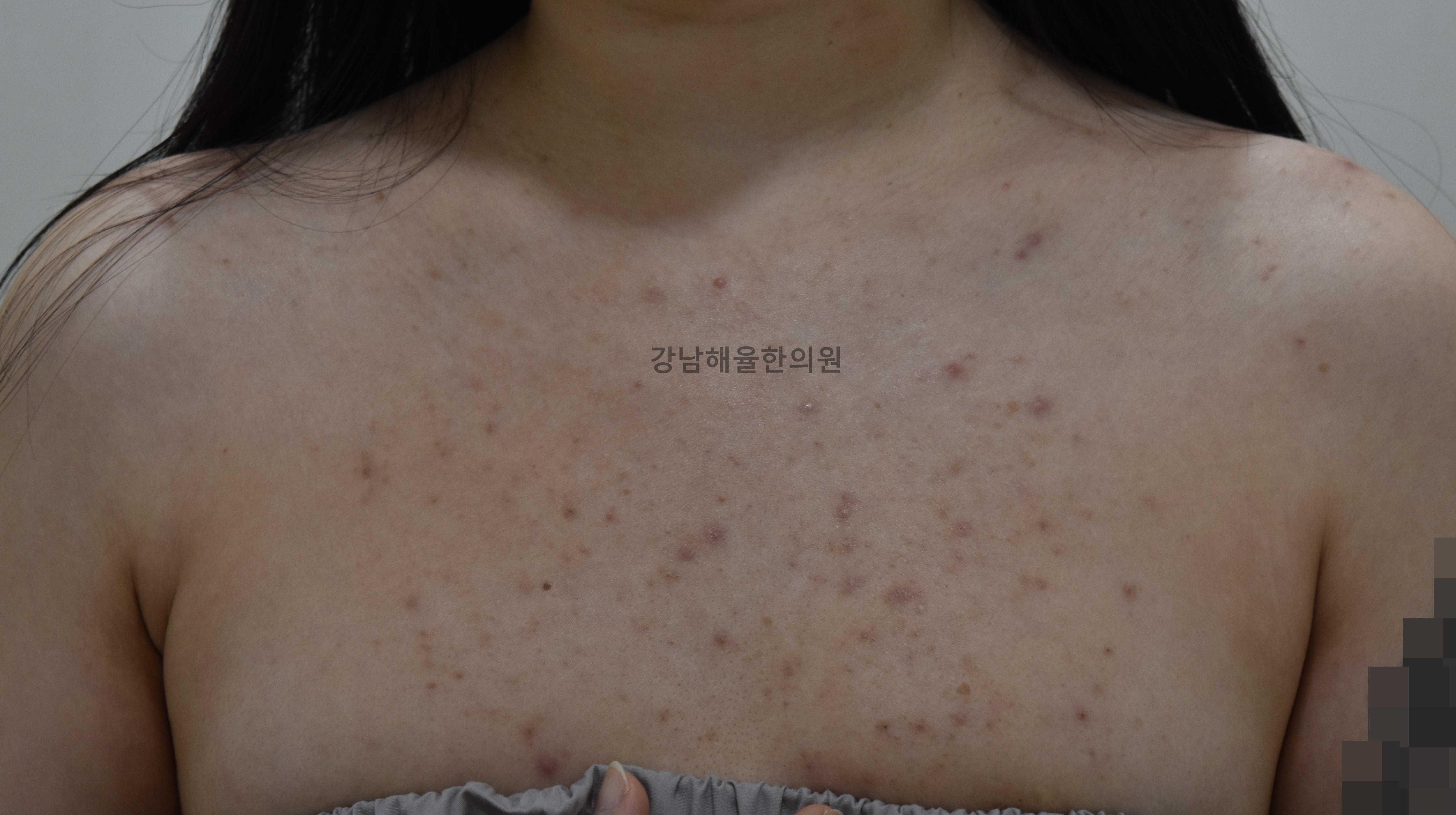 [강남점] 가슴여드름 치료 전 사진 - 해율한의원