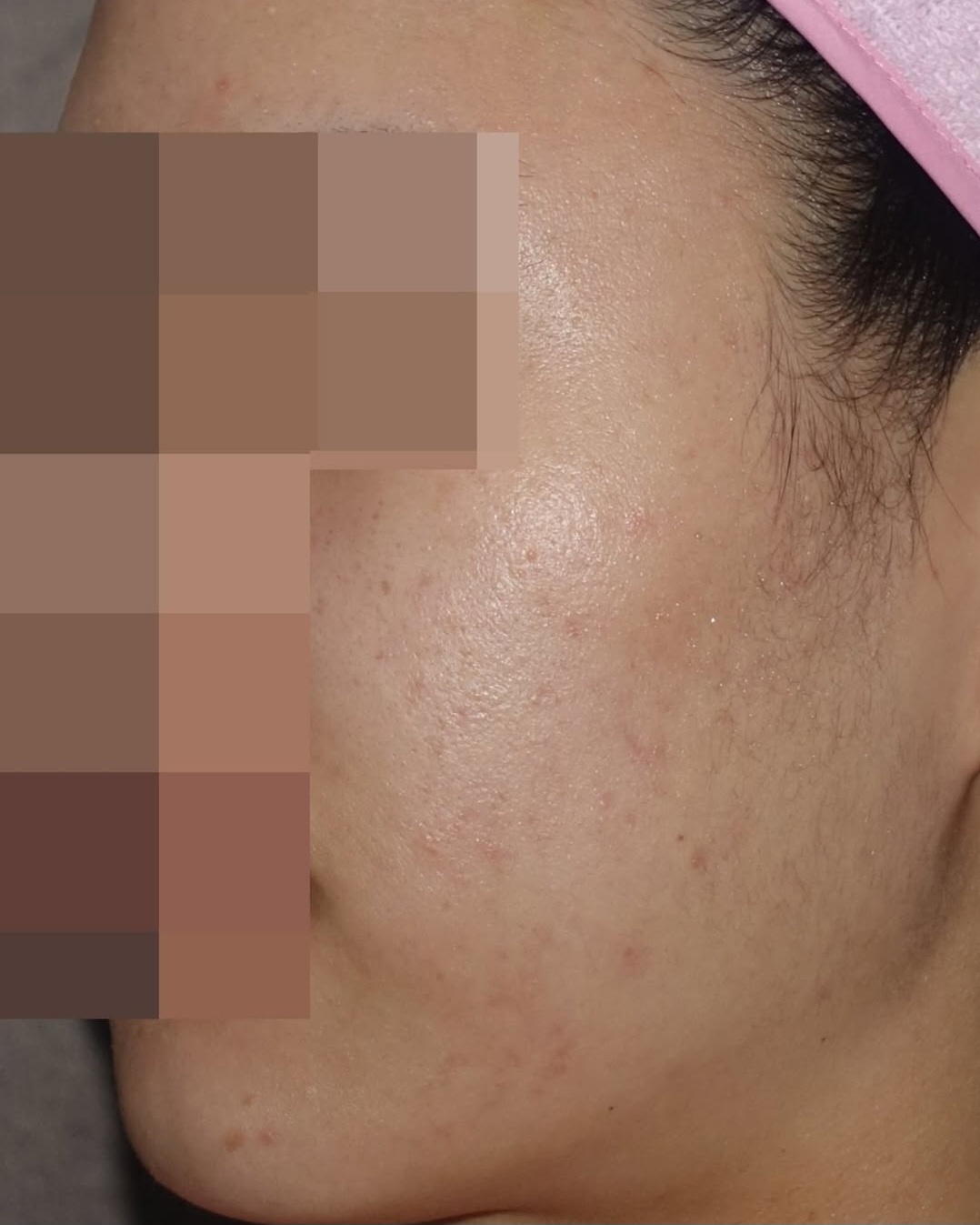 [홍대점] 여드름흉터 치료 후 사진 - 해율한의원