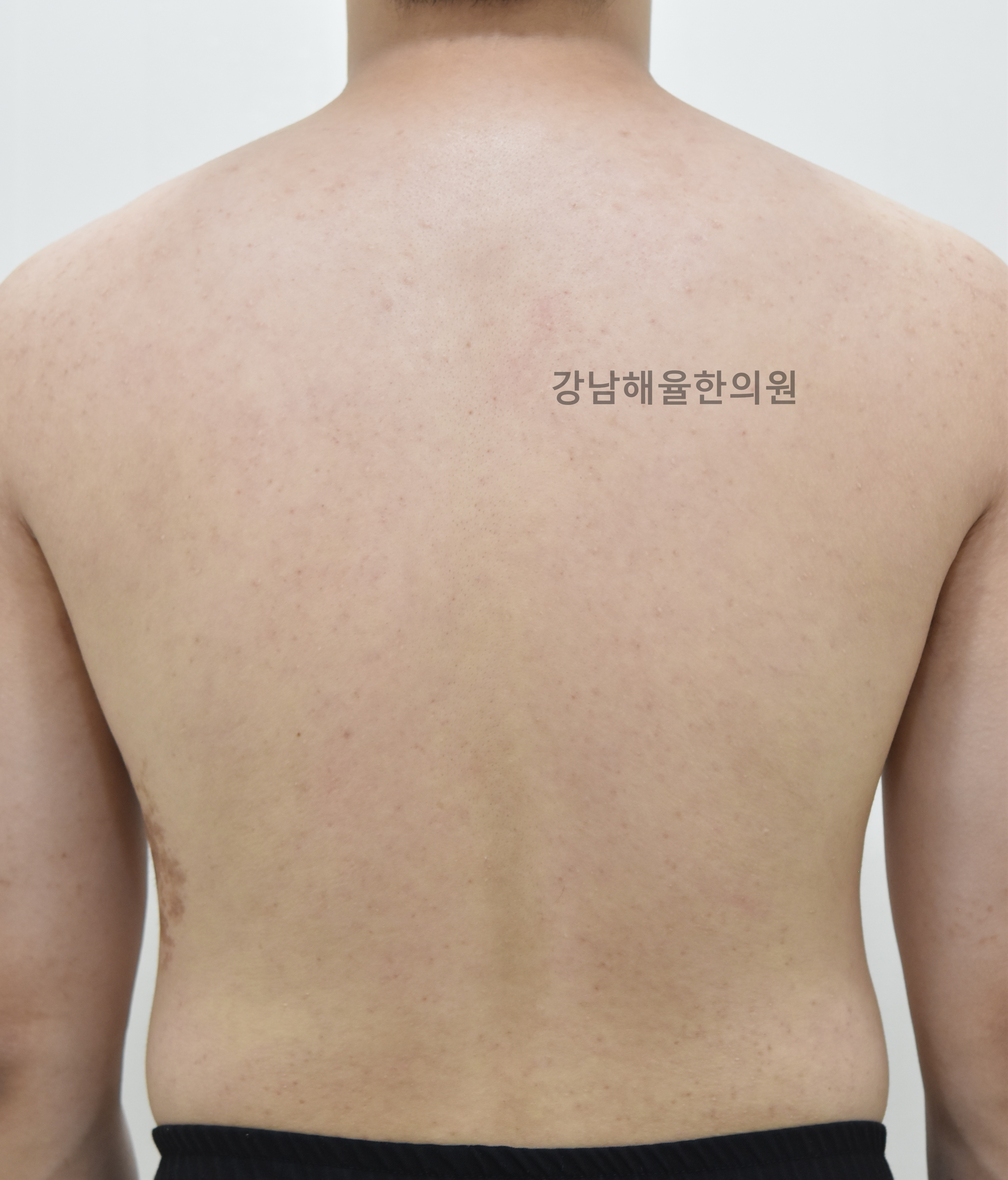 [강남점] 등여드름 치료 후 사진 - 해율한의원
