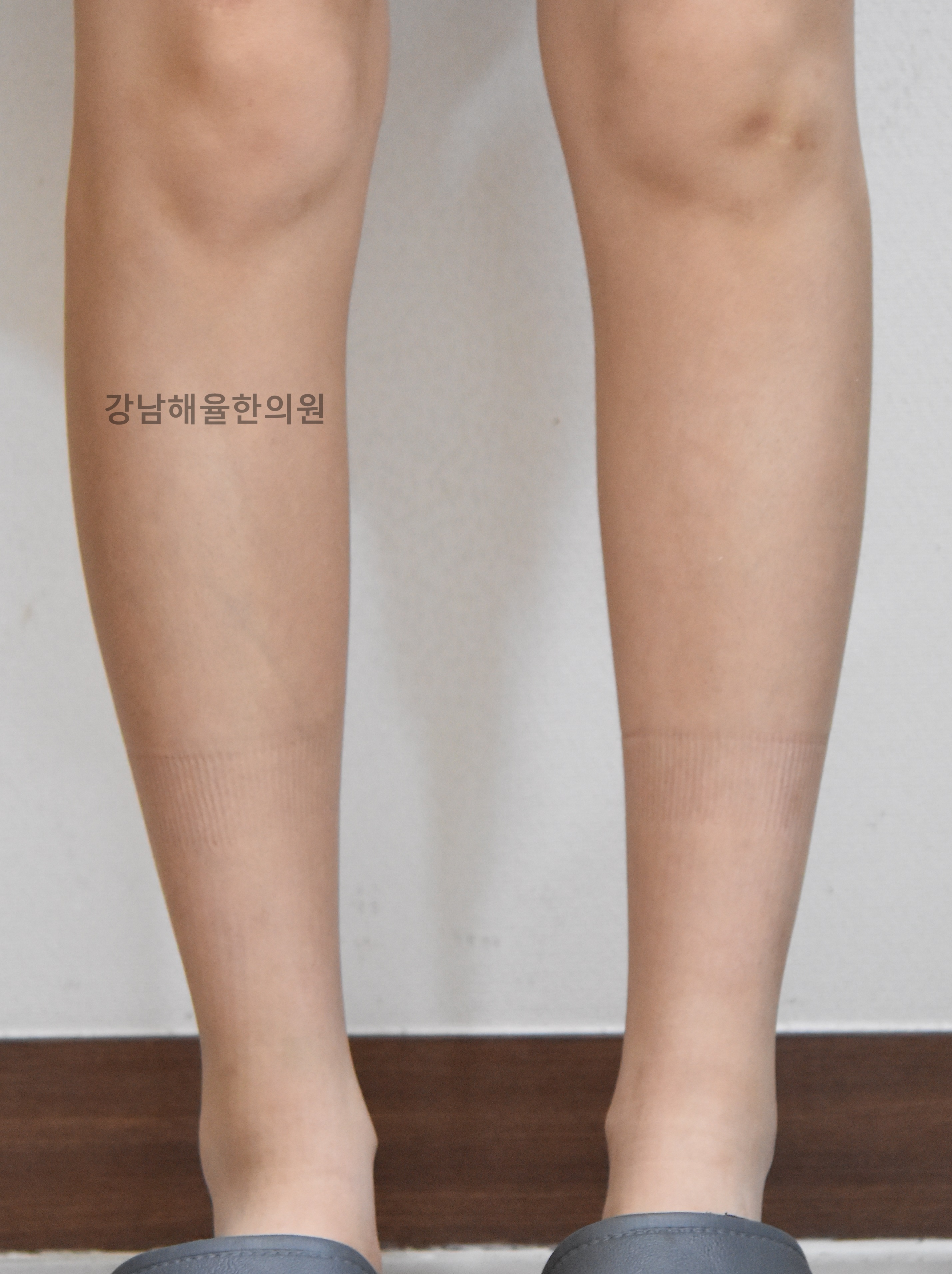 [강남점] 팔다리 색소자국 치료 후 사진 - 해율한의원