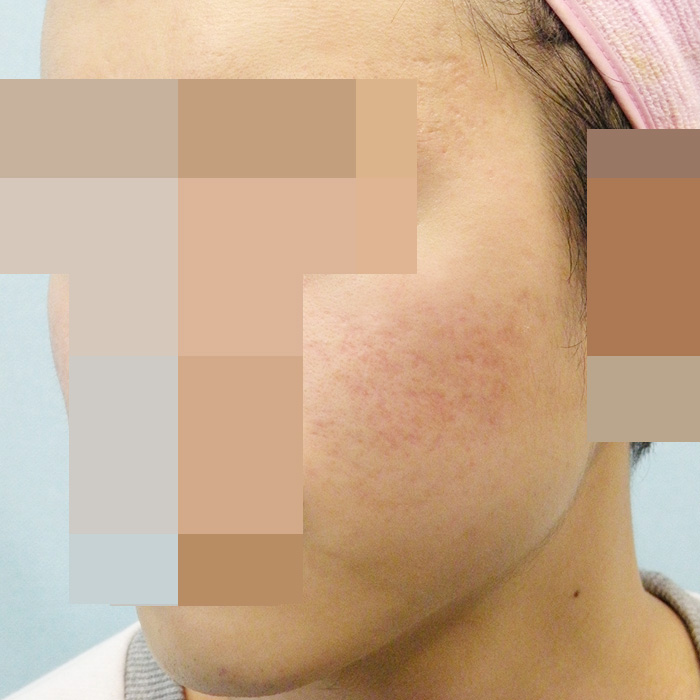 [홍대점] 여드름흉터 치료 후 사진 - 해율한의원