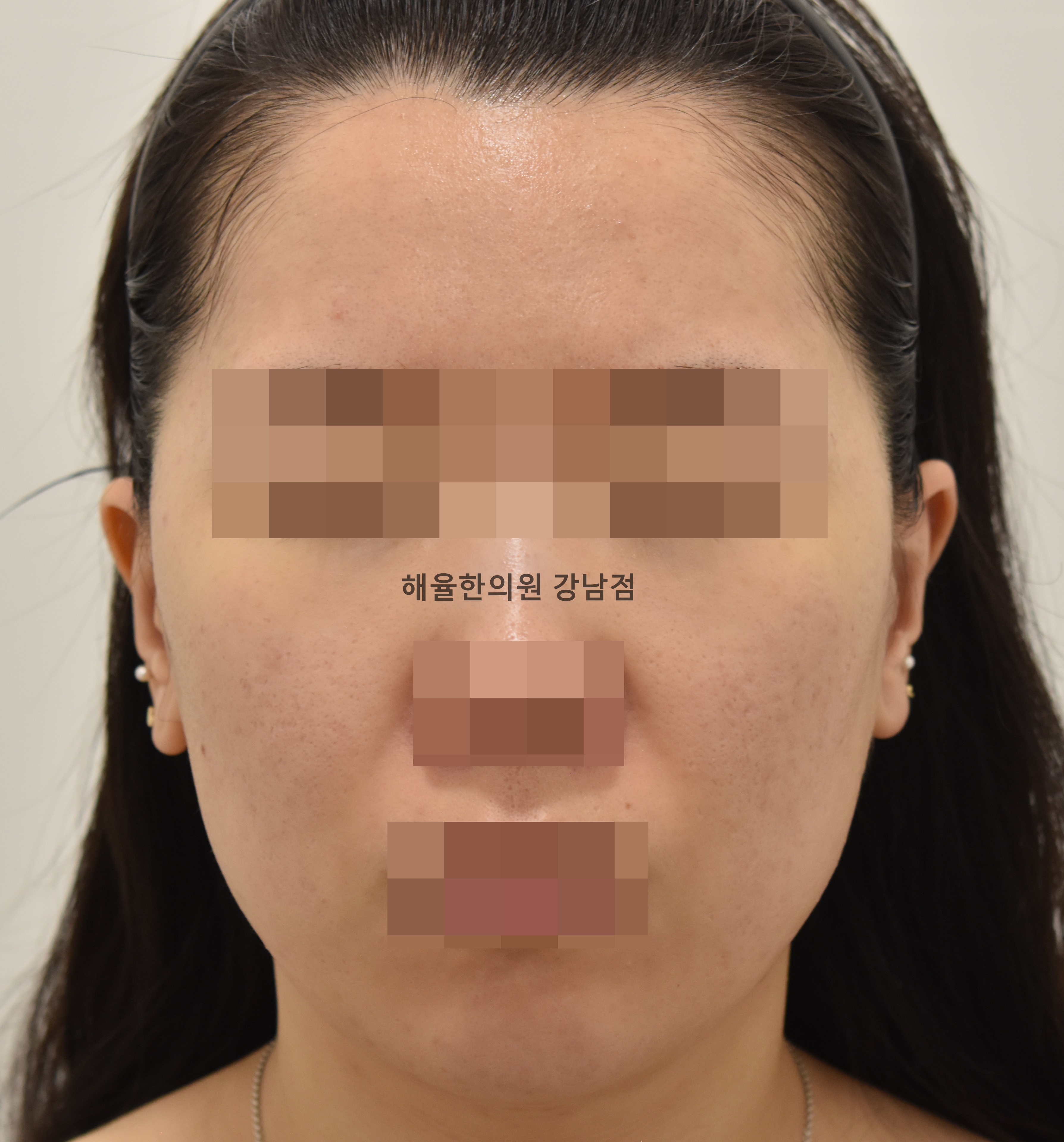 [강남점] 여드름흉터 치료 후 사진 - 해율한의원