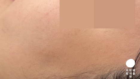 [수원점] 편평사마귀 치료 후 사진 - 해율한의원