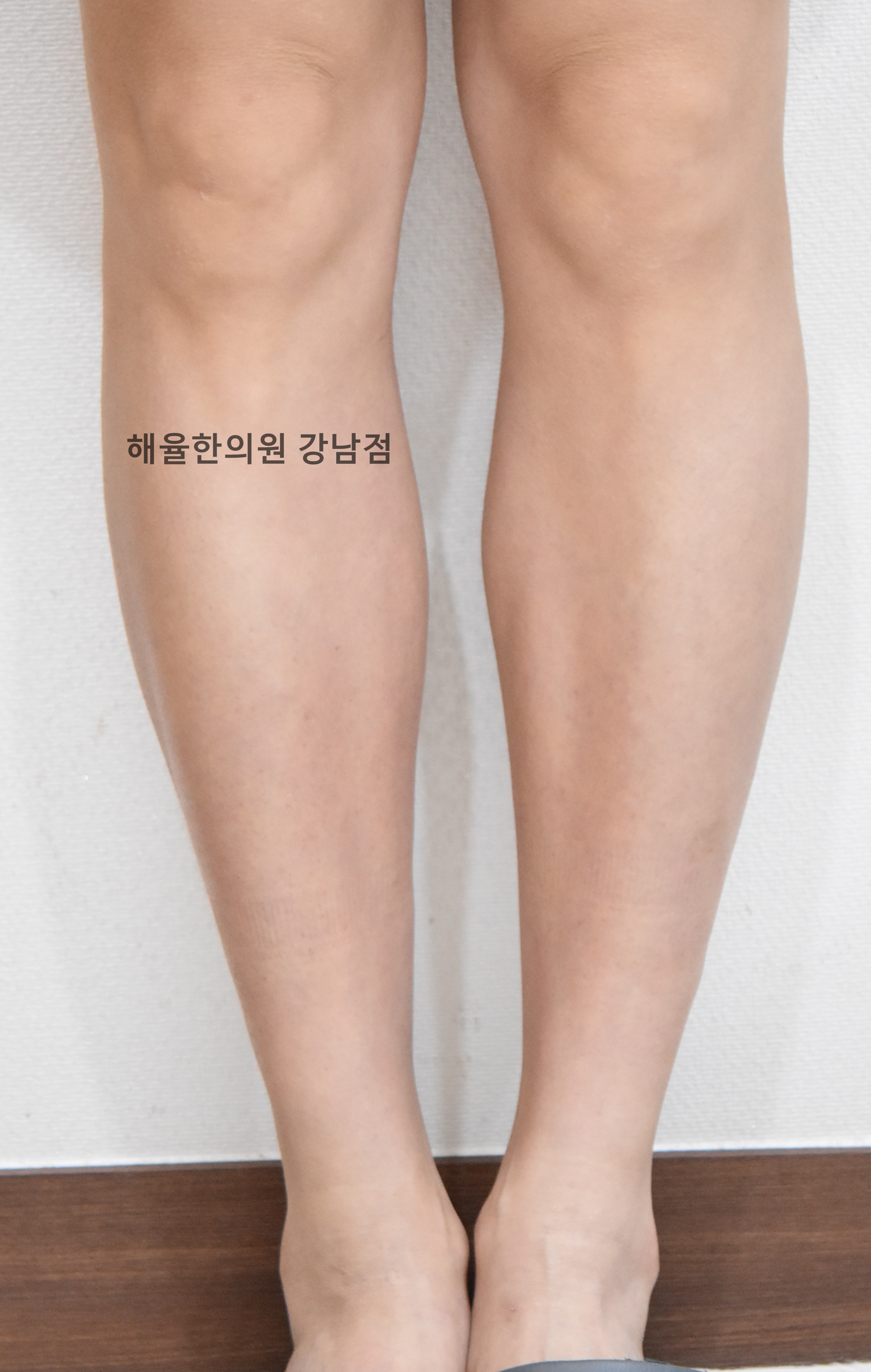 [강남점] 팔다리 색소자국 치료 후 사진 - 해율한의원