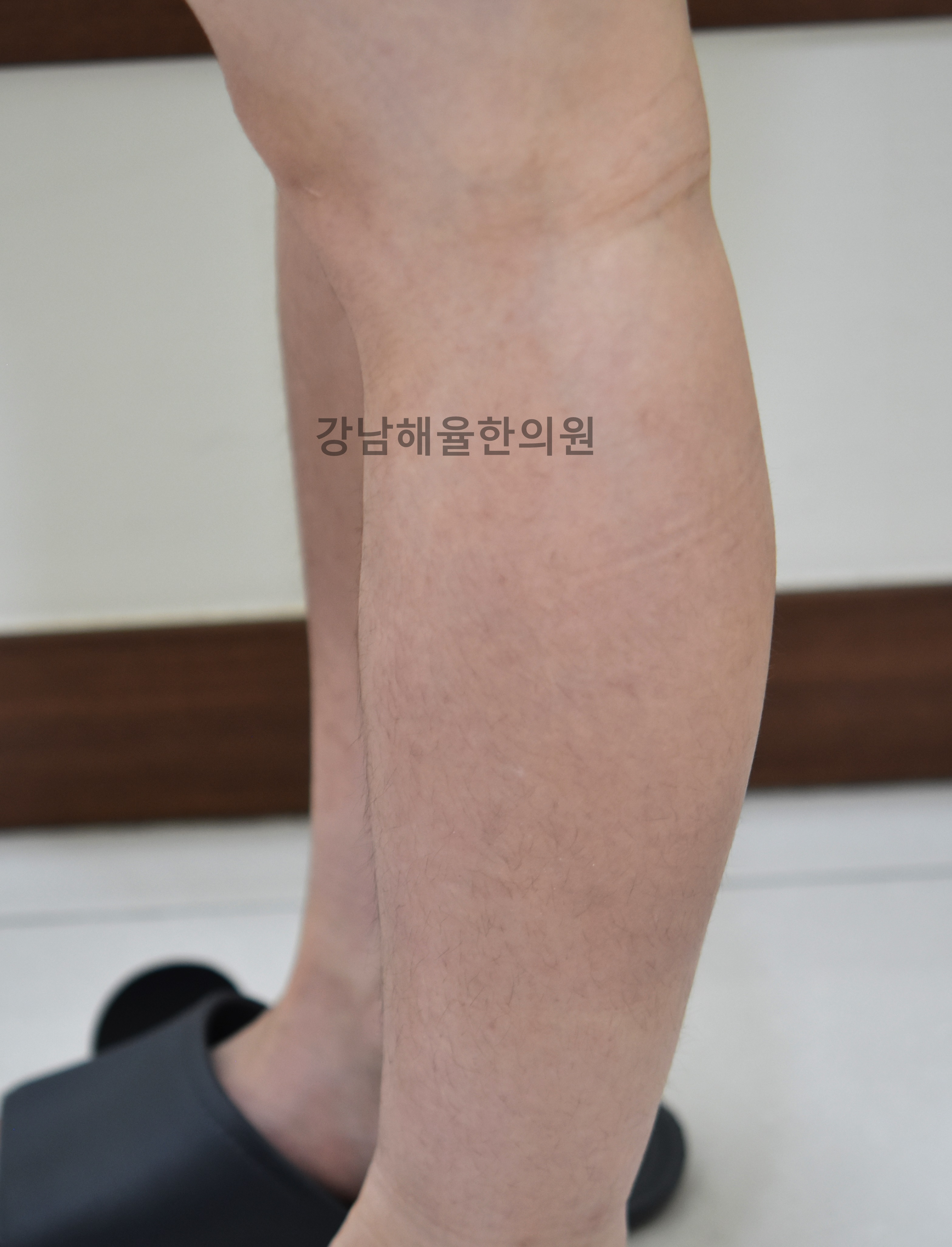 [강남점] 팔다리 색소자국 치료 후 사진 - 해율한의원