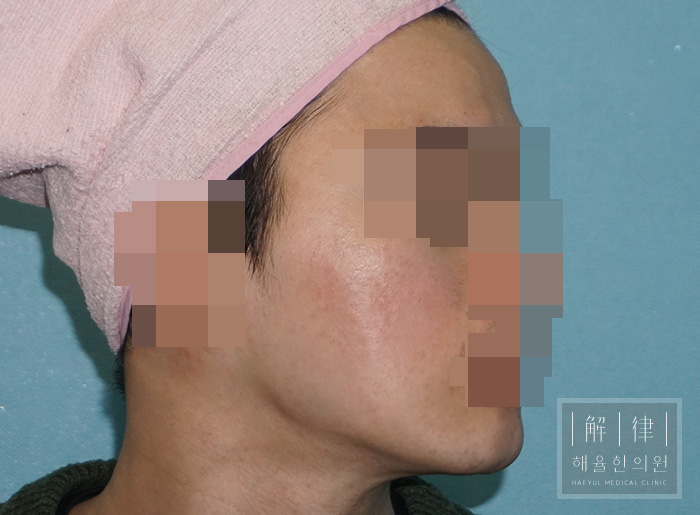 [홍대점] 여드름흉터 치료 후 사진 - 해율한의원