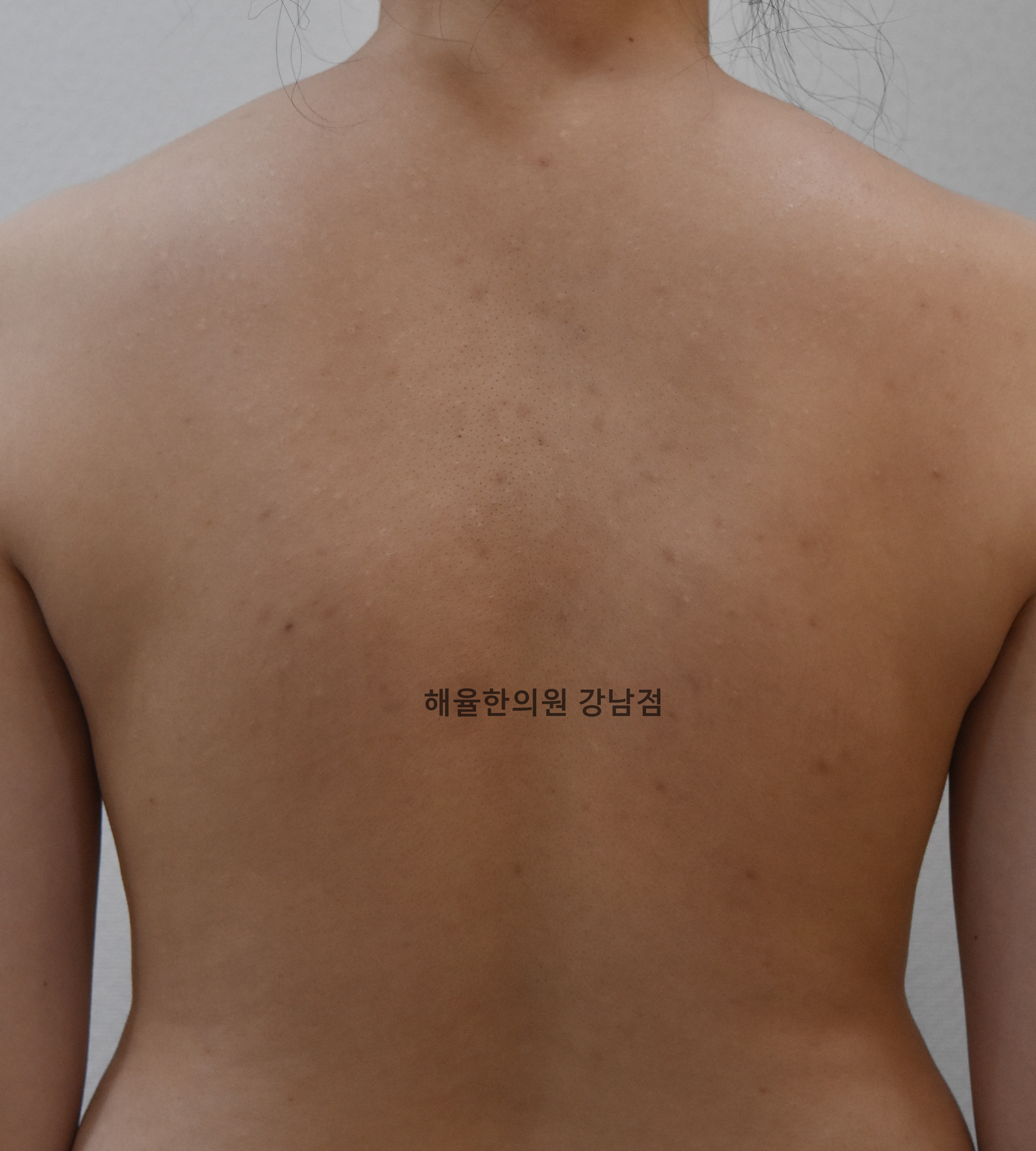 [강남점] 등여드름 치료 후 사진 - 해율한의원