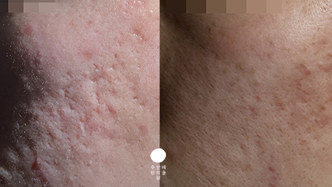 [수원점] 여드름흉터 치료 전 사진 - 해율한의원