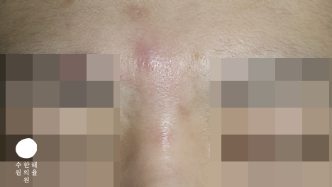 [수원점] 여드름흉터 치료 후 사진 - 해율한의원