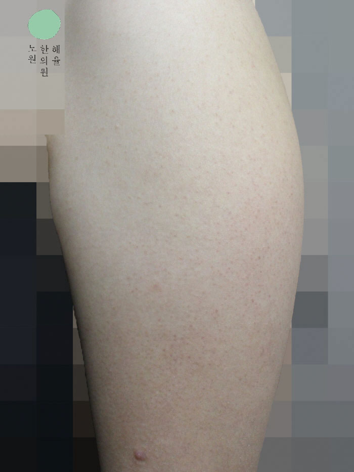 [노원점] 모공각화증 치료 후 사진 - 해율한의원