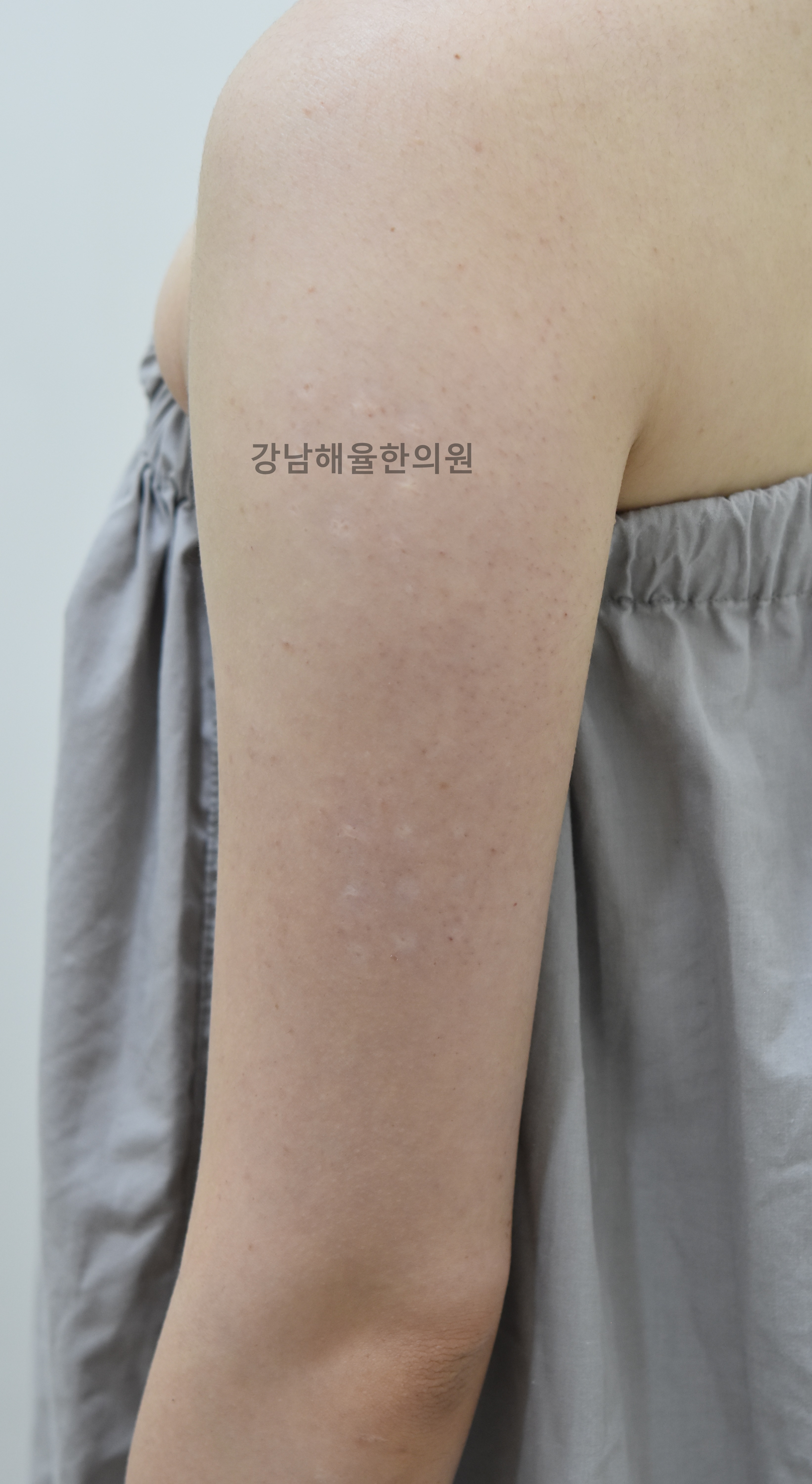 [강남점] 모공각화증 치료 후 사진 - 해율한의원